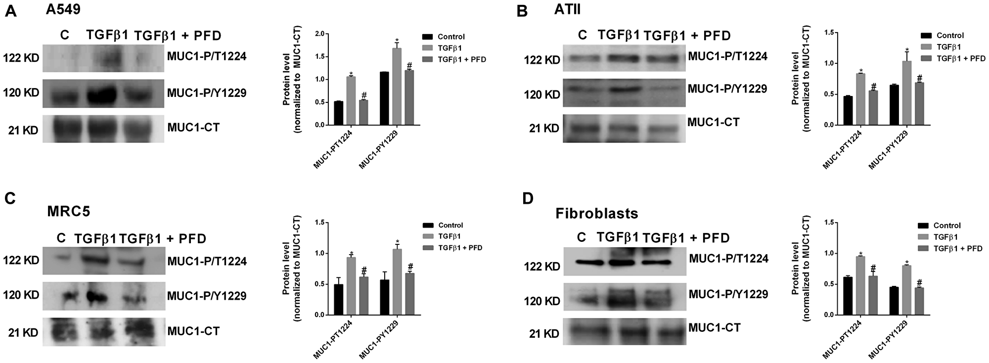 Pirfenidone (PFD) supresses the TGF-β1-induced MUC1-cytoplasmic tail (CT) bioactivation: ATII cells were isolated from the lungs of control subjects, and lung fibroblasts were isolated from the lungs of IPF patients