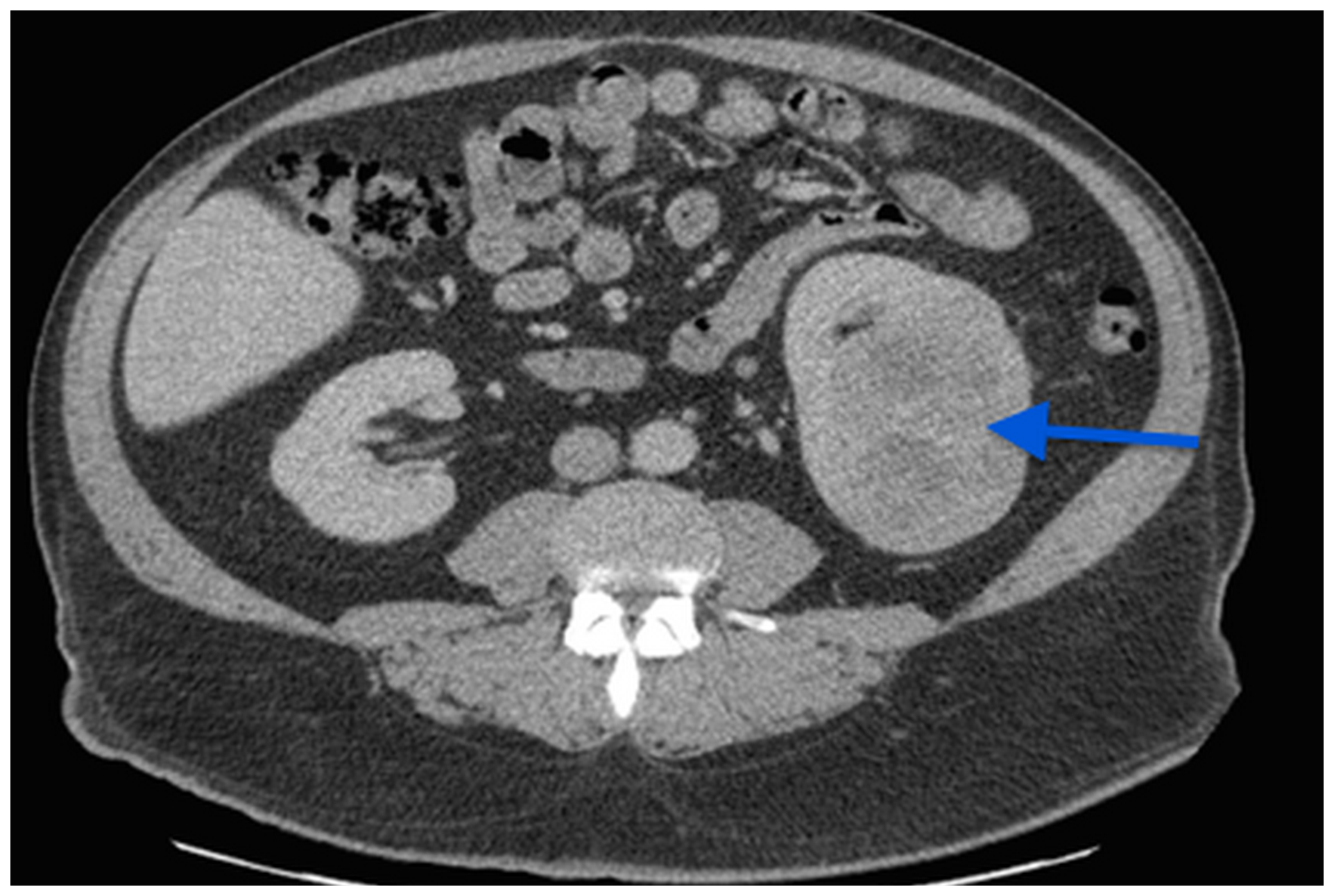 Figure 1: A CT scan image showing a 7 cm left kidney mass.