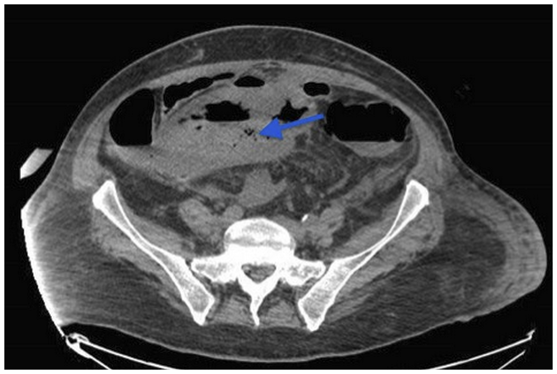 CT scan of the abdomen and pelvis revealed the presence of gas inside the pelvic mass (arrow) due to fistulisation of an intestinal loop with localized peritonitis