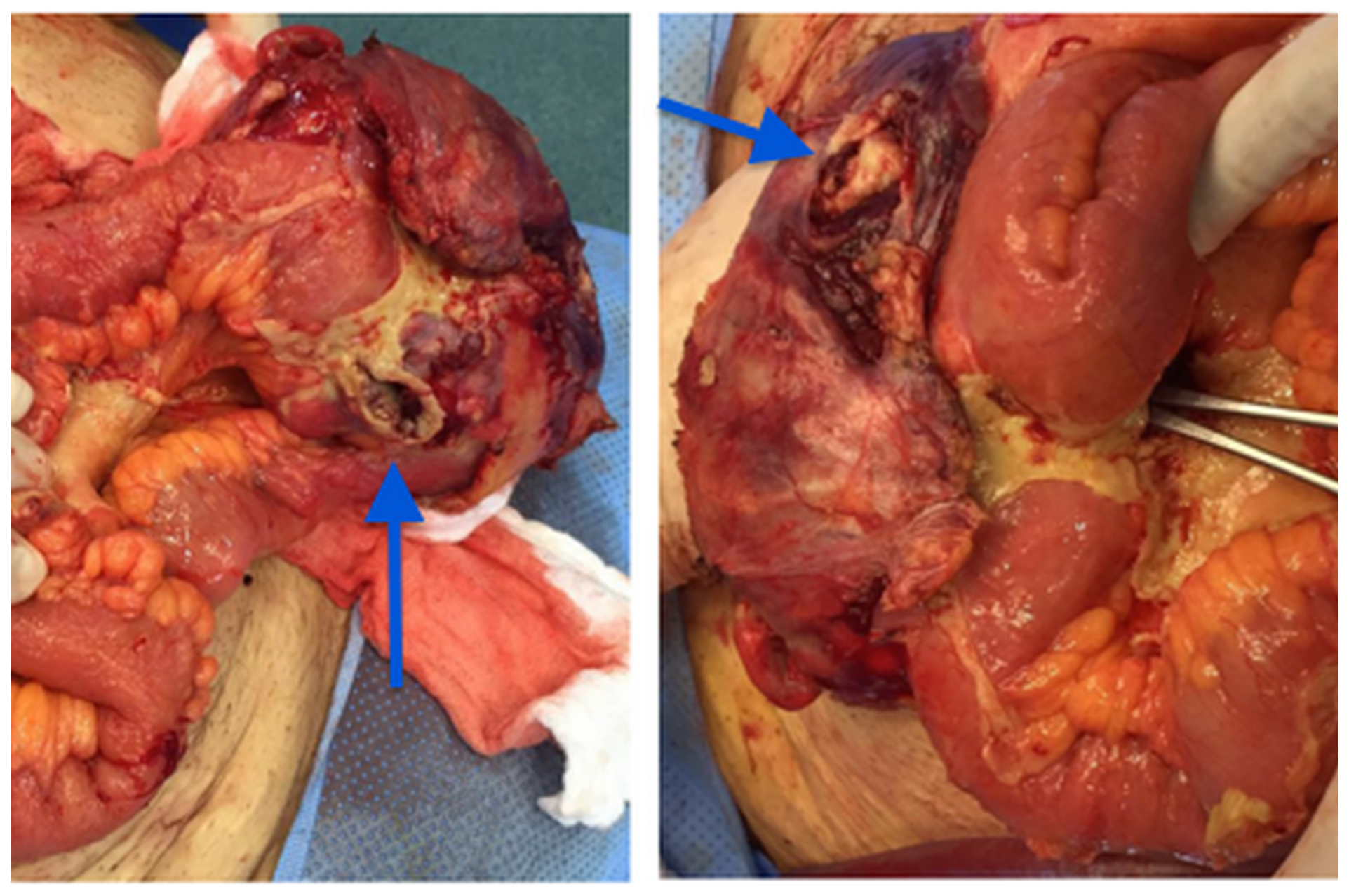 Right inguinal mass in communication with the intestinal loop (arrows)