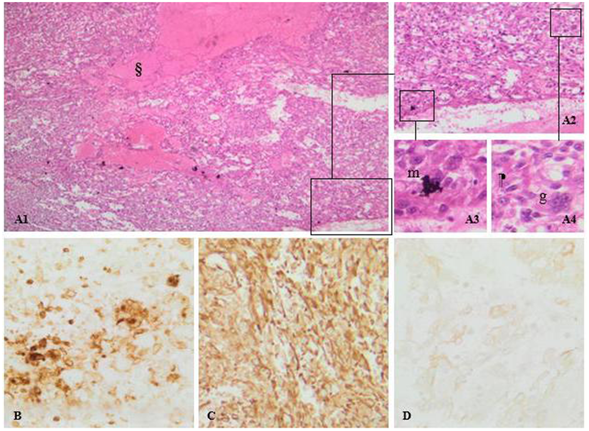 (A) Sarcomatoid renal cell carcinoma, PAX 8 positive, PDL1 negative. Pictures A1, A2, A3 and A4: H&E staining photomicrographs shows pleimorphic atypical spindle cells (m), along with multinucleated giant cells (g) arising from clear cell renal cell carcinoma. Note the mitotic activity and the area of necrosis (§). (B) CD10 expression confirms the clear cell type of the tumor. Diffuse vimentin stain positivity. (C) sarcomatoid differentiation of the tumor. (D) mild cytokeratin staining thus, an epithelial origin.