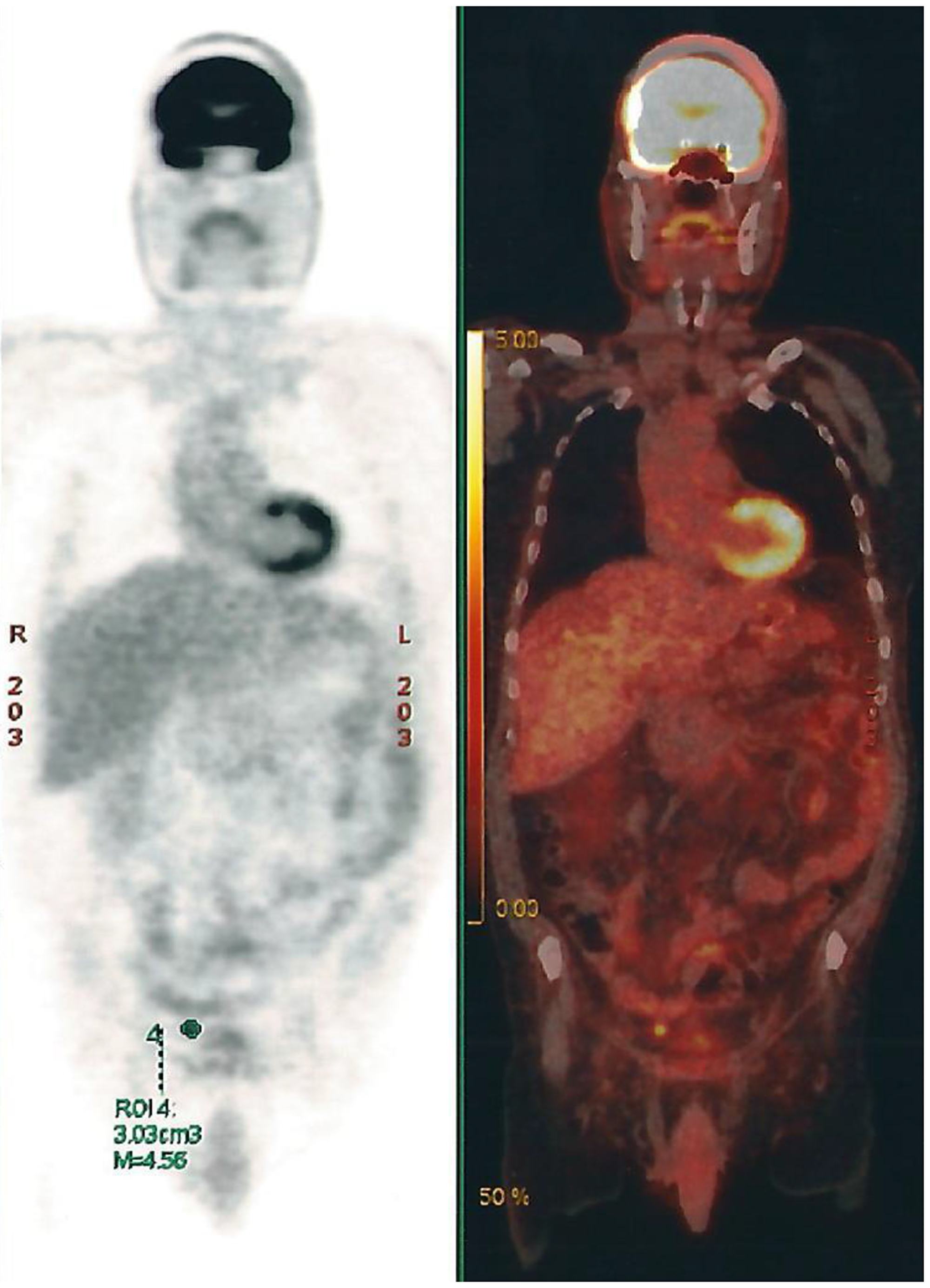 PET-CT Scan showing multiple retroperitoneal, pelvic and abdominal lymph nodes
