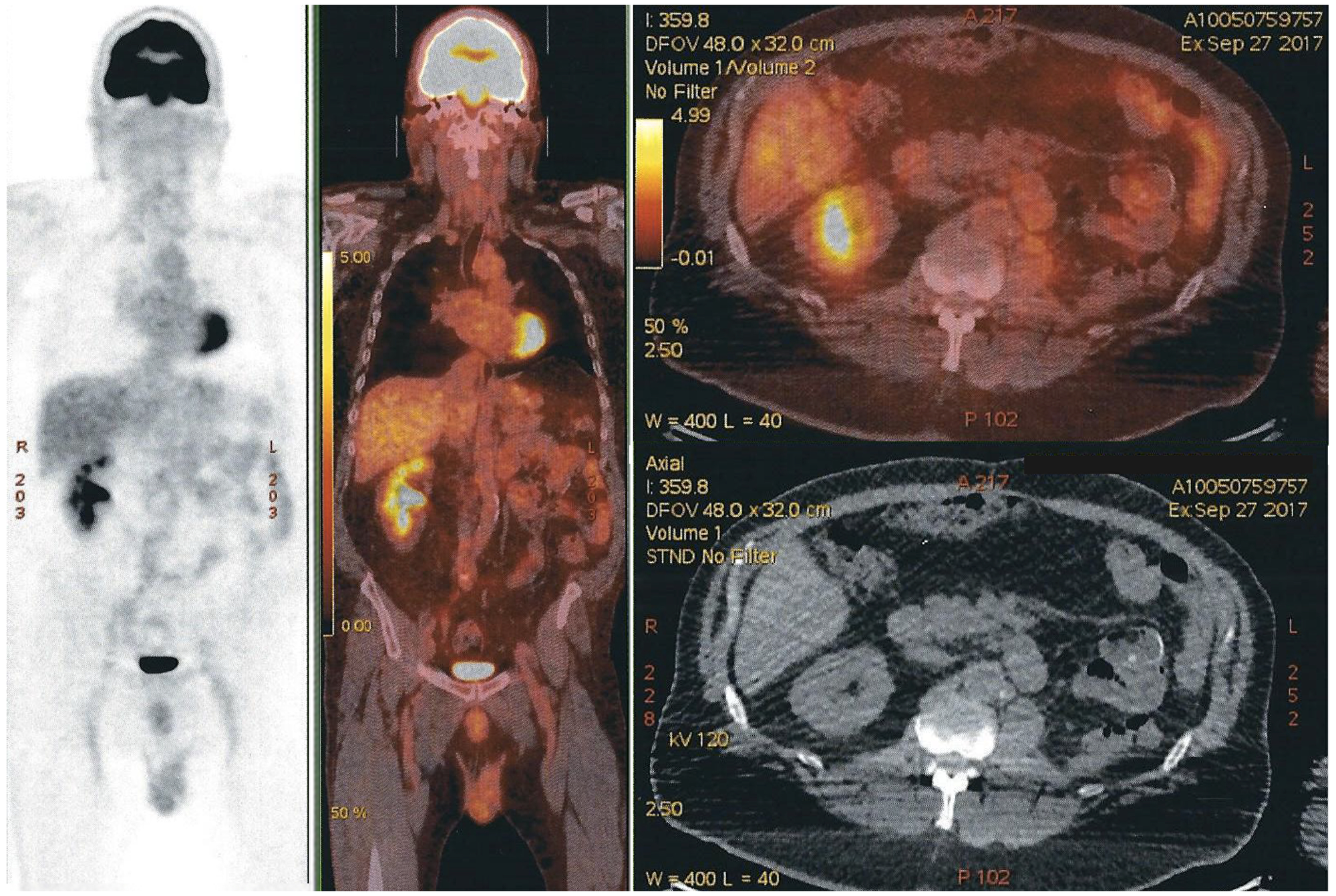 PET-CT scan with no evidence of recurrence of oncologic disease