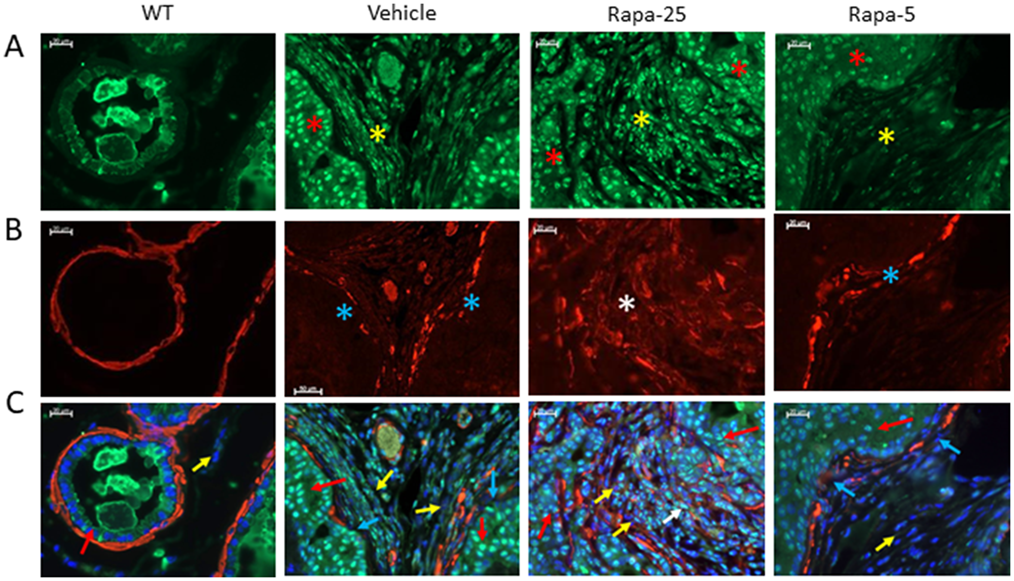 Dysregulation of TGFβ signaling correlates with development of reactive stroma in prostates of psPten–/– mice treated with high dose Rapatar