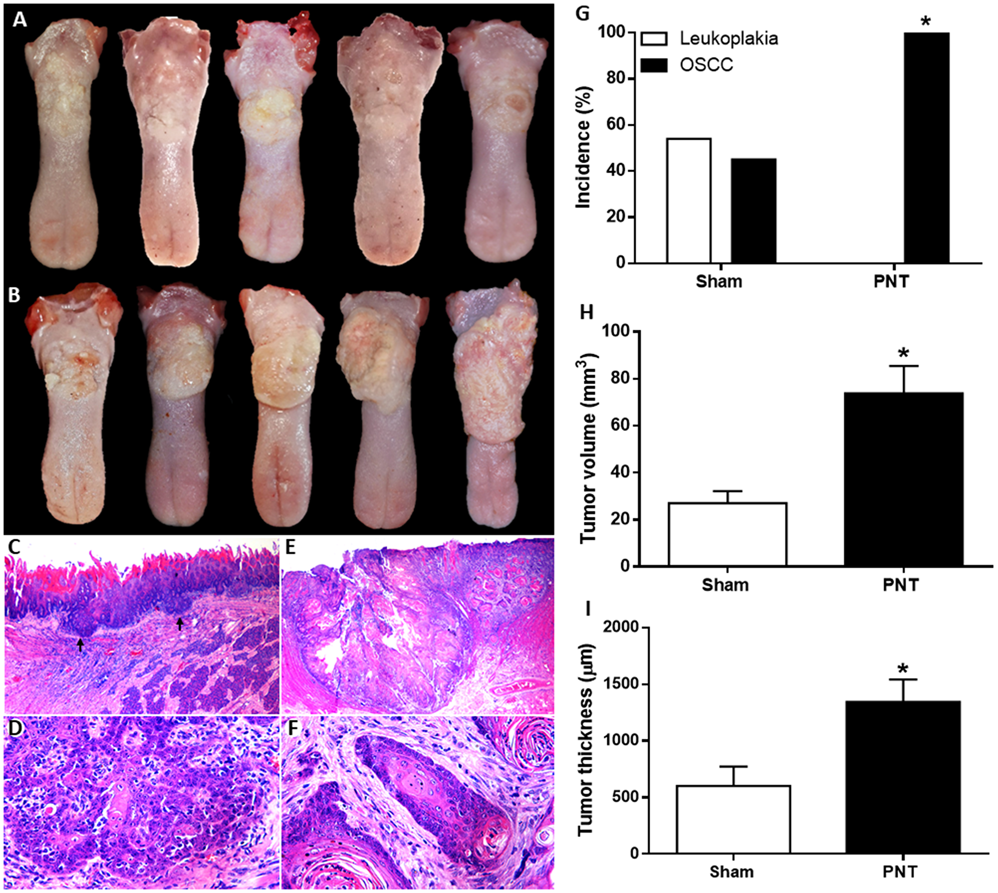 <em><strong>Figure 1:</strong> Clinical features of OSCCs derived from 4NQO treatment in sham (<strong>A</strong>) and PNT rats (<strong>B</strong>). (A) Small irregular white plates and discrete ulcerative lesions. (B) Extensive ulcerative lesions displaying reddish and yellowish-white areas. Histopathological features of tongue tumors from sham (<strong>C</strong> and<strong> D</strong>) and PNT rats (<strong>E</strong> and<strong> F</strong>) (H&E staining). (C) Well-differentiated OSCC (black arrows) (original magnification &times;250). (D) Tumor cells showing hyperchromatism and dyskeratosis (original magnification &times;400). (E) Extensive well-differentiated OSCC (original magnification &times;250). (F) Islands of well-differentiated tumor cells with nuclear pleomorphism and keratin pearls (original magnification &times;400). Occurrence and progression of OSCC in sham and PNT animals. (<strong>G</strong>) Chi-square test revealed that PNT rats had a higher OSCC occurrence than sham rats. (<strong>H</strong>) Student's<em> t</em>-test showed that PNT group had increased tumor volume when compared to sham group. (<strong>I</strong>) PNT rats exhibited higher tumor thickness than sham-operated animals. (sham,<em> n</em> = 11; PNT,<em> n</em> = 12). Bars represent the mean &plusmn; SEM.<sup> *</sup><em>p</em> < 0.05. The Figure 1E was spliced for joining together two images due to the extent of the tumor.</em></p> <p>Melatonin treatment may inhibit cancer progression and <a href=