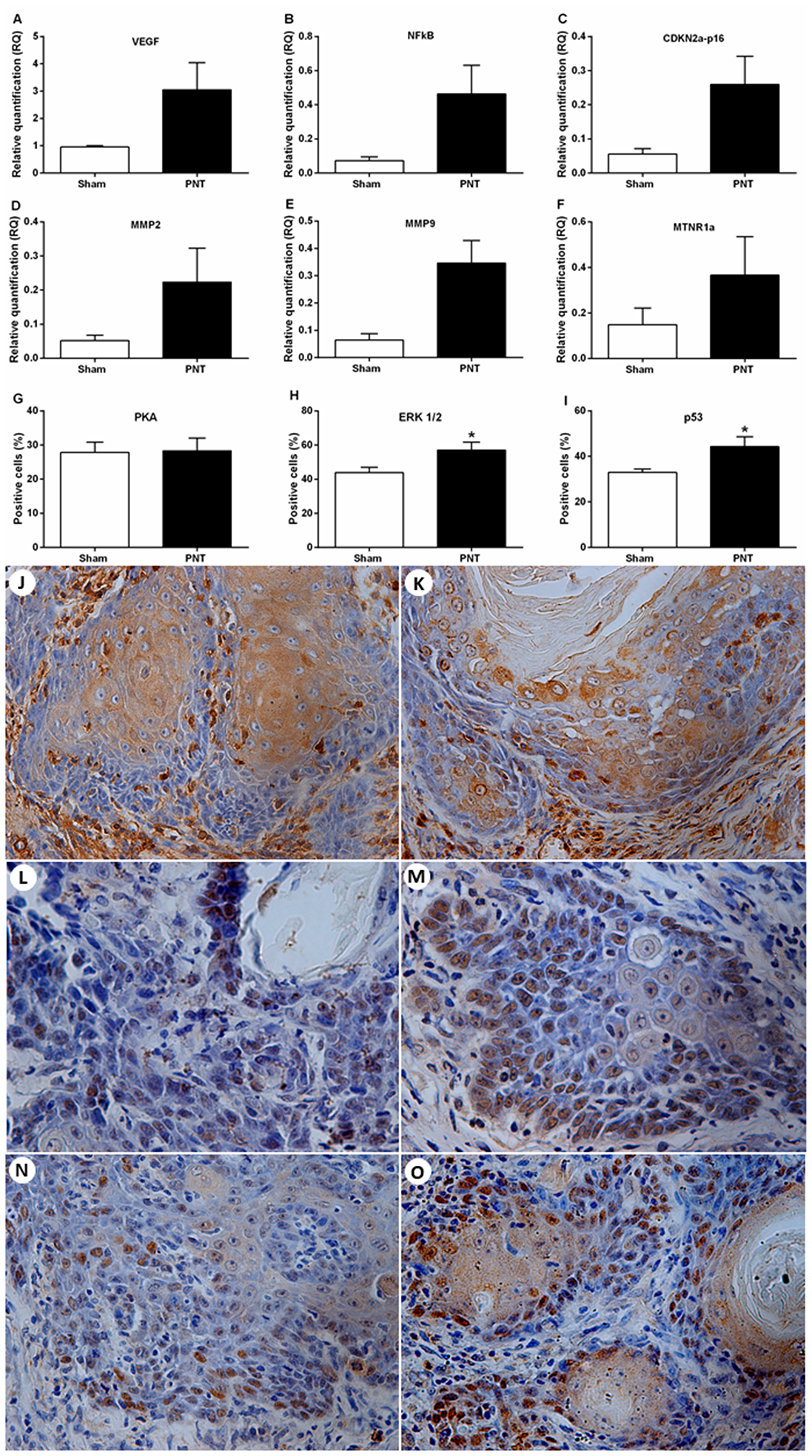 Expression of tumor progression-related genes and melatonin receptors and immunostaining for PKA, ERK1/2 and p53 in the OSCC microenvironment