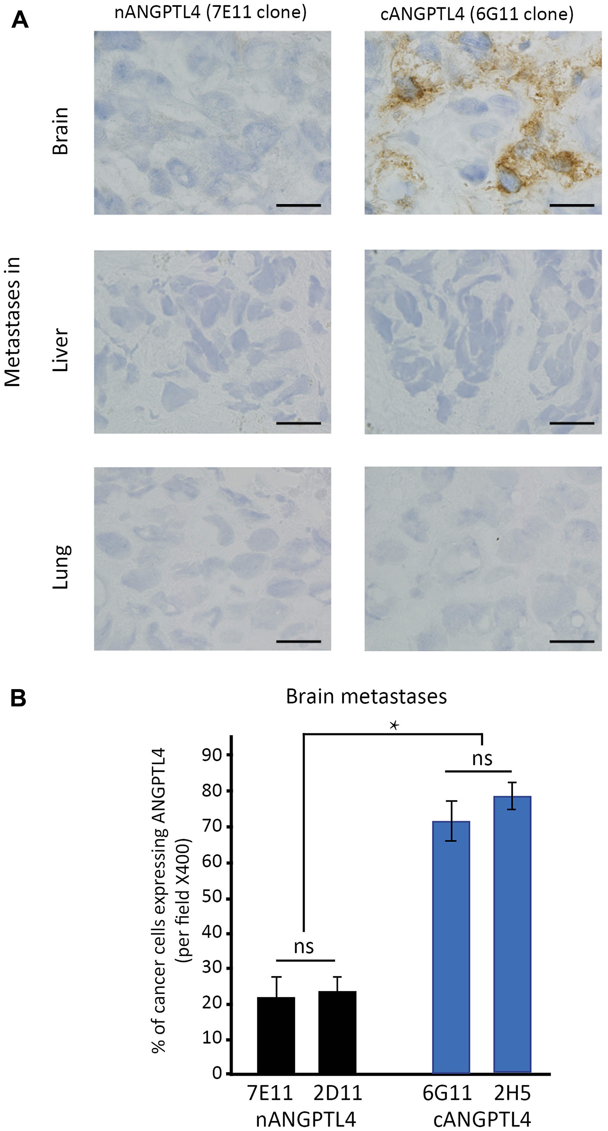 Differential expression of ANGPTL4 fragments in brain metastases of women with breast cancer