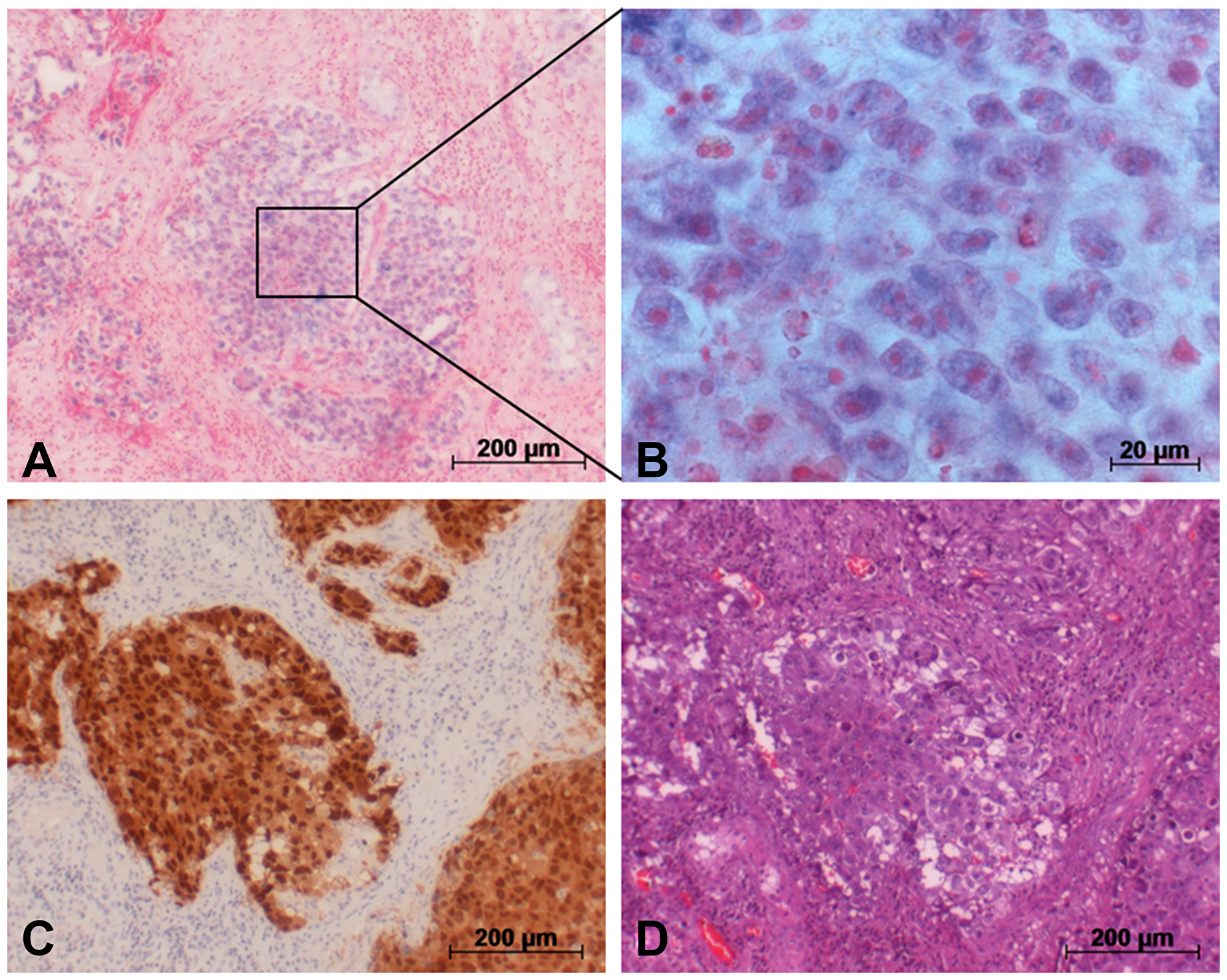 Detection of miR-371a-3p in GCT tumor (EC) via in situ hybridization