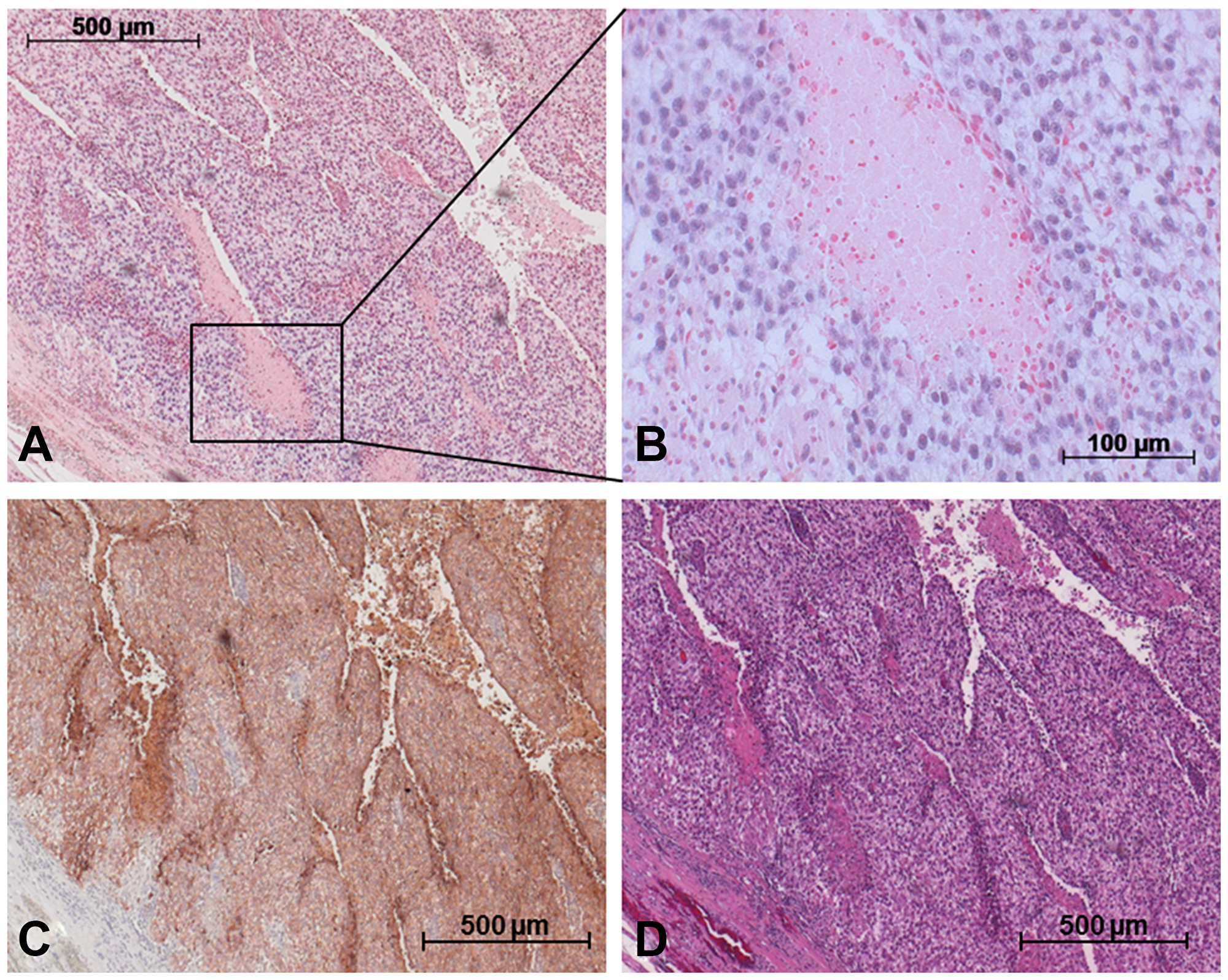 Detection of miR-371a-3p in GCT mixed tumor including SE and YST via in situ hybridization