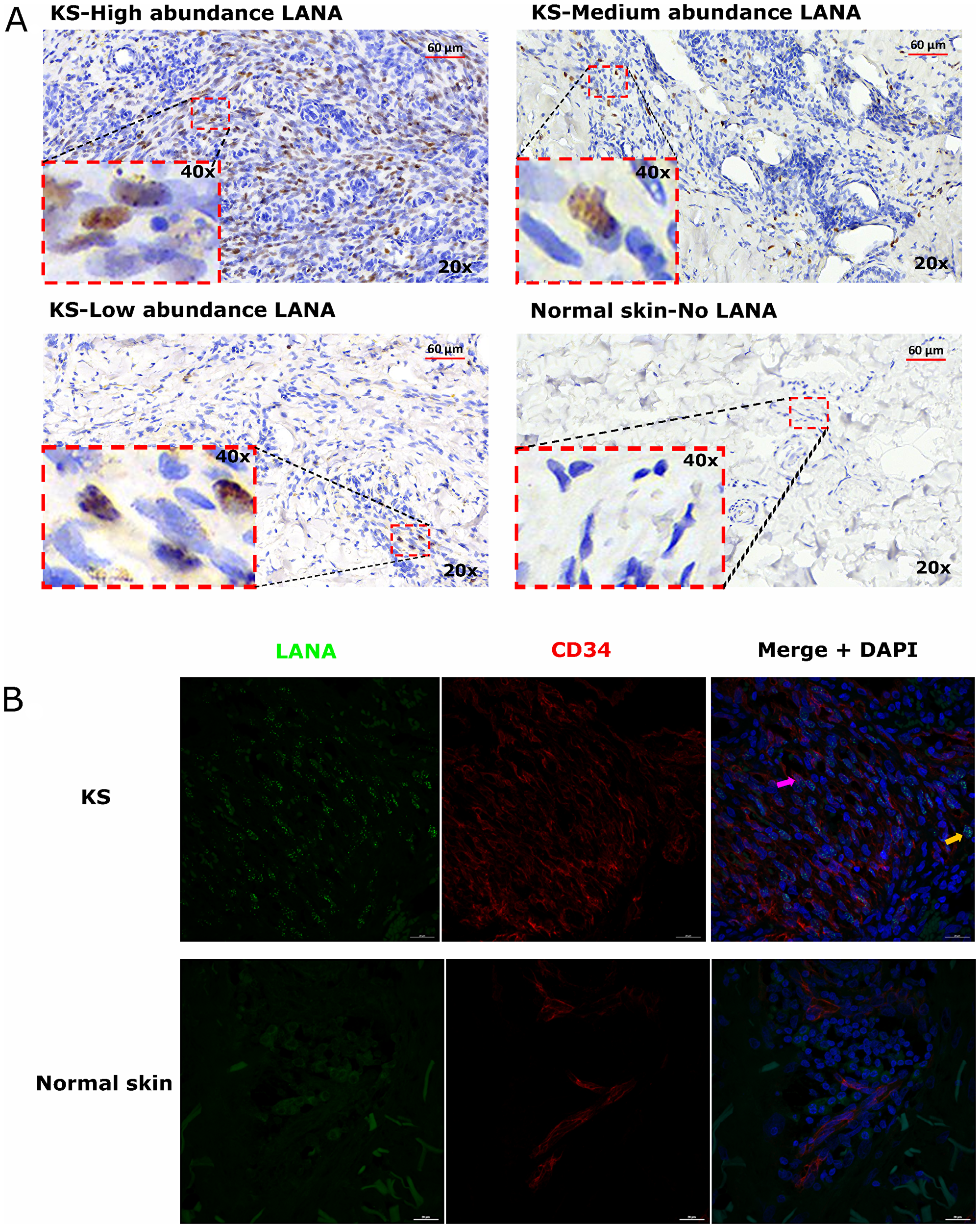 (A) Representative images showing varying abundancies of Kaposi’s Sarcoma-associated Herpesvirus (KSHV) Latency Associated Nuclear Antigen (LANA) protein on Kaposi’s Sarcoma (KS) tissues and normal skin by immunohistochemistry (IHC) staining. Representative images at 20× and 40× magnification are shown for KS tissue with high abundance LANA positive cells ID-21242, medium abundance LANA positive cells ID-21230, low abundance LANA positive cells ID-21229 and normal skin with no LANA positive cells ID-C063-control. (B) Dual-immunofluorescence staining of Kaposi’s Sarcoma-associated Herpesvirus (KSHV) Latency Associated Nuclear Antigen (LANA) protein and endothelial cell surface marker CD34 on Kaposi’s Sarcoma (KS) tissues ID-C3096 and normal skin ID-21650. Representative images are shown, Alexa 488 (green) for LANA, Alexa 647 (red) for CD34 and 4’,6-Diamino-2-Phenylindole, Dihydrochloride (DAPI) (blue) for nuclei staining. Pink arrow – LANA positive and CD34 positive cell, Orange arrow – LANA positive and CD34 negative cell.