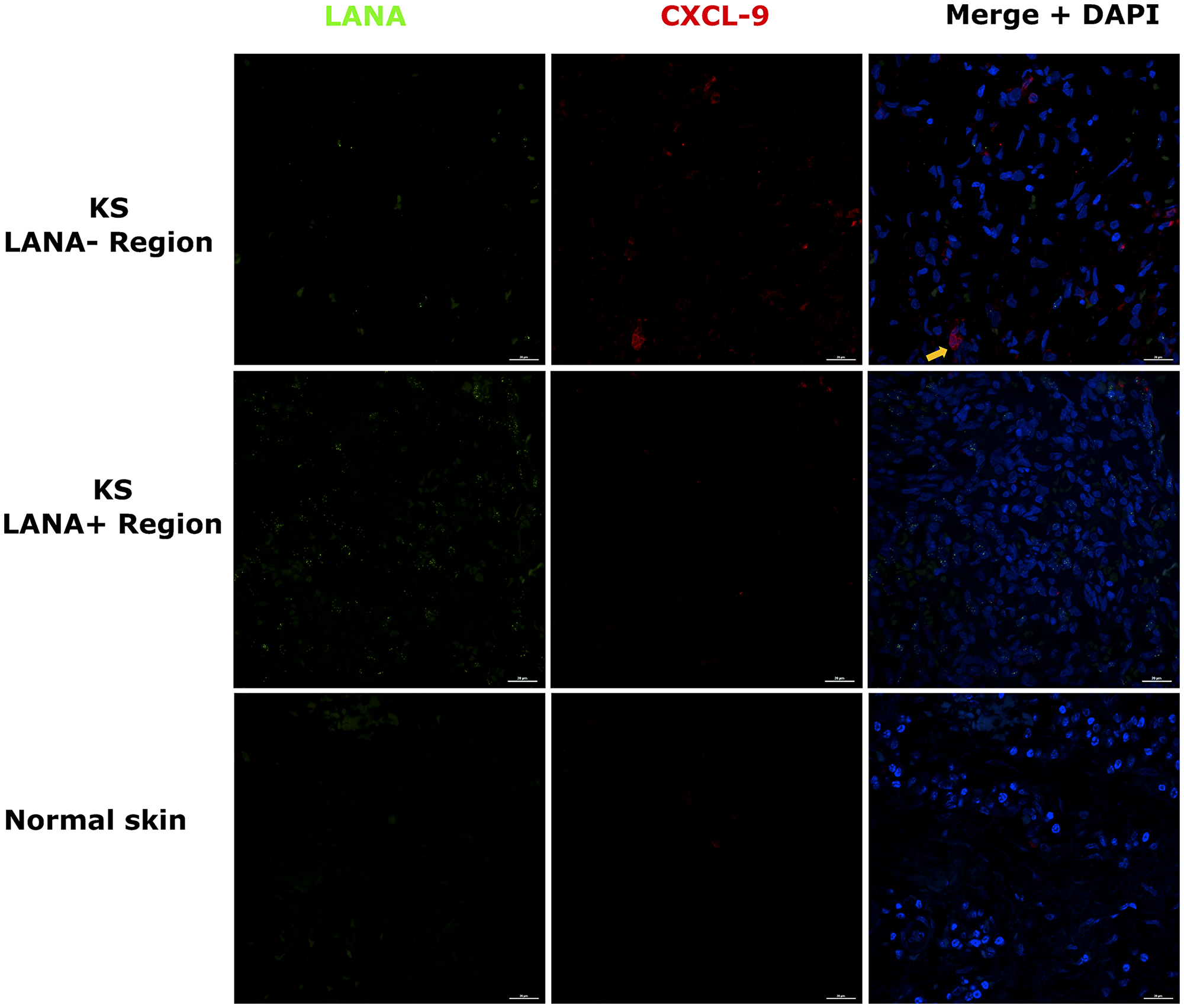 Dual-immunofluorescence staining of Kaposi’s sarcoma-associated Herpesvirus (KSHV) Latency Associated Nuclear Antigen (LANA) protein and C-X-C Motif Chemokine Ligand 9 (CxCL-9) on Kaposi’s Sarcoma (KS) tissues ID-C3057 (LANA+ and LANA- regions) and normal skin ID-21650
