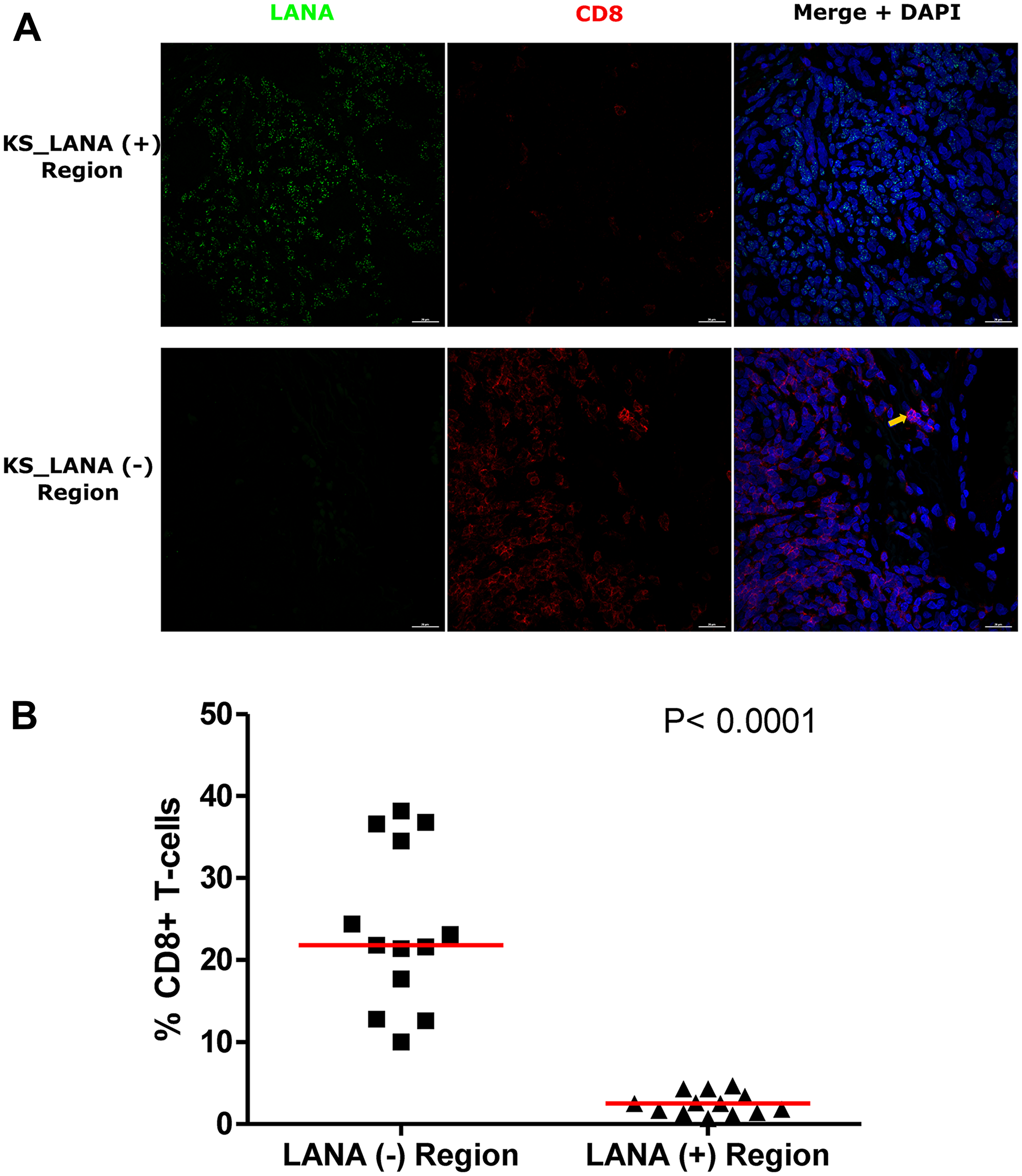 Dual-immunofluorescence staining of Kaposi’s Sarcoma-associated Herpesvirus (KSHV) Latency Associated Nuclear Antigen (LANA) protein and CD8+ T-cells on Kaposi’s Sarcoma (KS) tissues