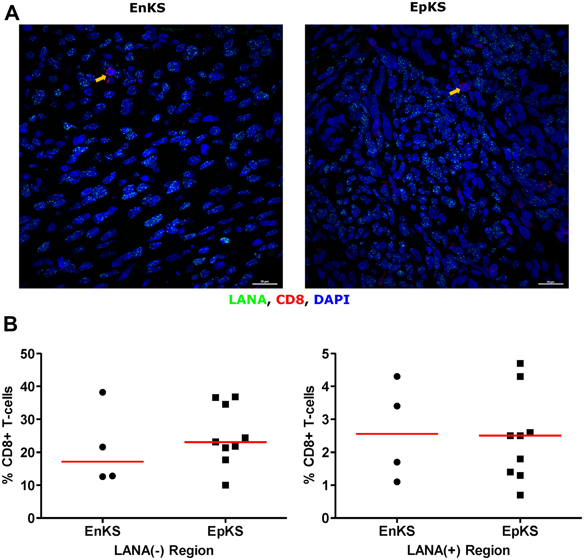 Dual-immunofluorescence staining of Kaposi’s Sarcoma-associated Herpesvirus (KSHV) Latency Associated Nuclear Antigen (LANA) protein and CD8+ T-cells on Kaposi’s Sarcoma (KS) tissues