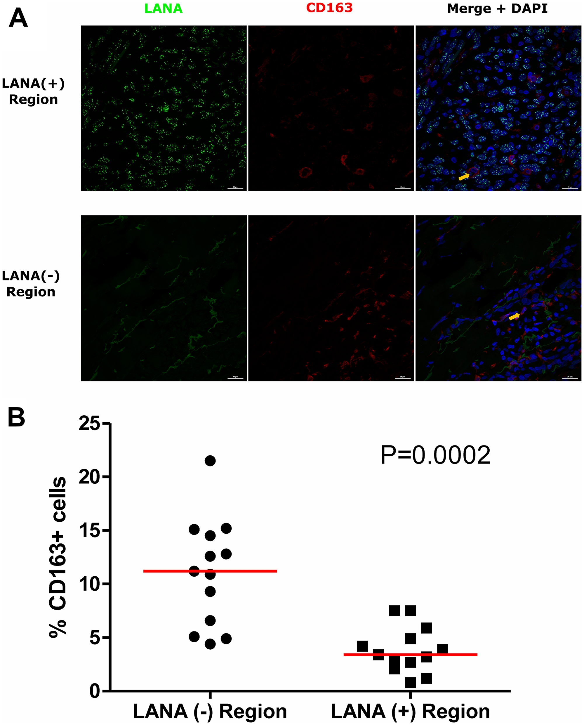 Dual-immunofluorescence staining of Kaposi’s Sarcoma-associated Herpesvirus (KSHV) Latency Associated Nuclear Antigen (LANA) protein and CD163 on Kaposi’s Sarcoma (KS) tissues