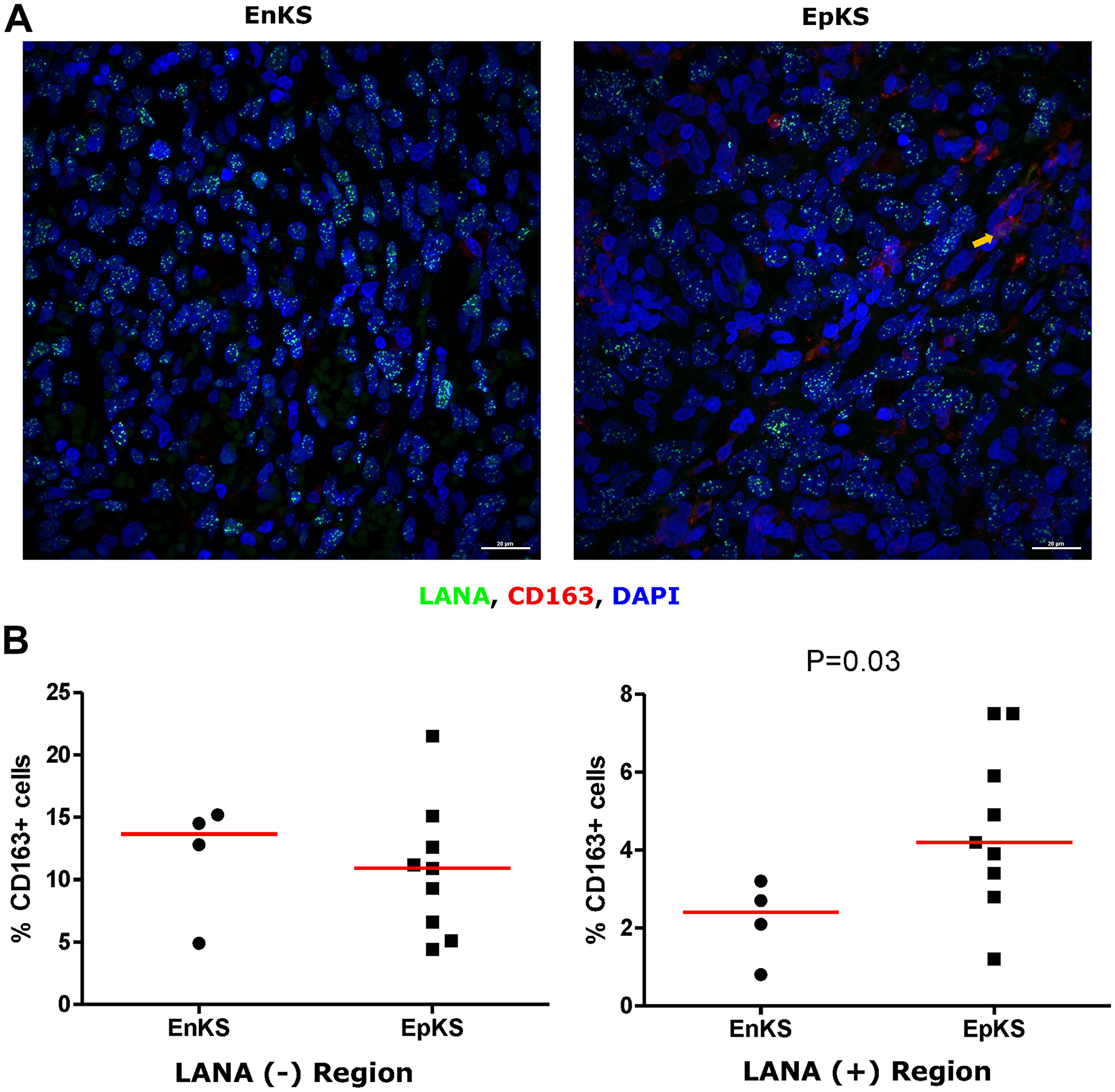 Dual-immunofluorescence staining of Kaposi’s Sarcoma-associated Herpesvirus (KSHV) Latency Associated Nuclear Antigen (LANA) protein and CD163 on Kaposi’s Sarcoma (KS) tissues
