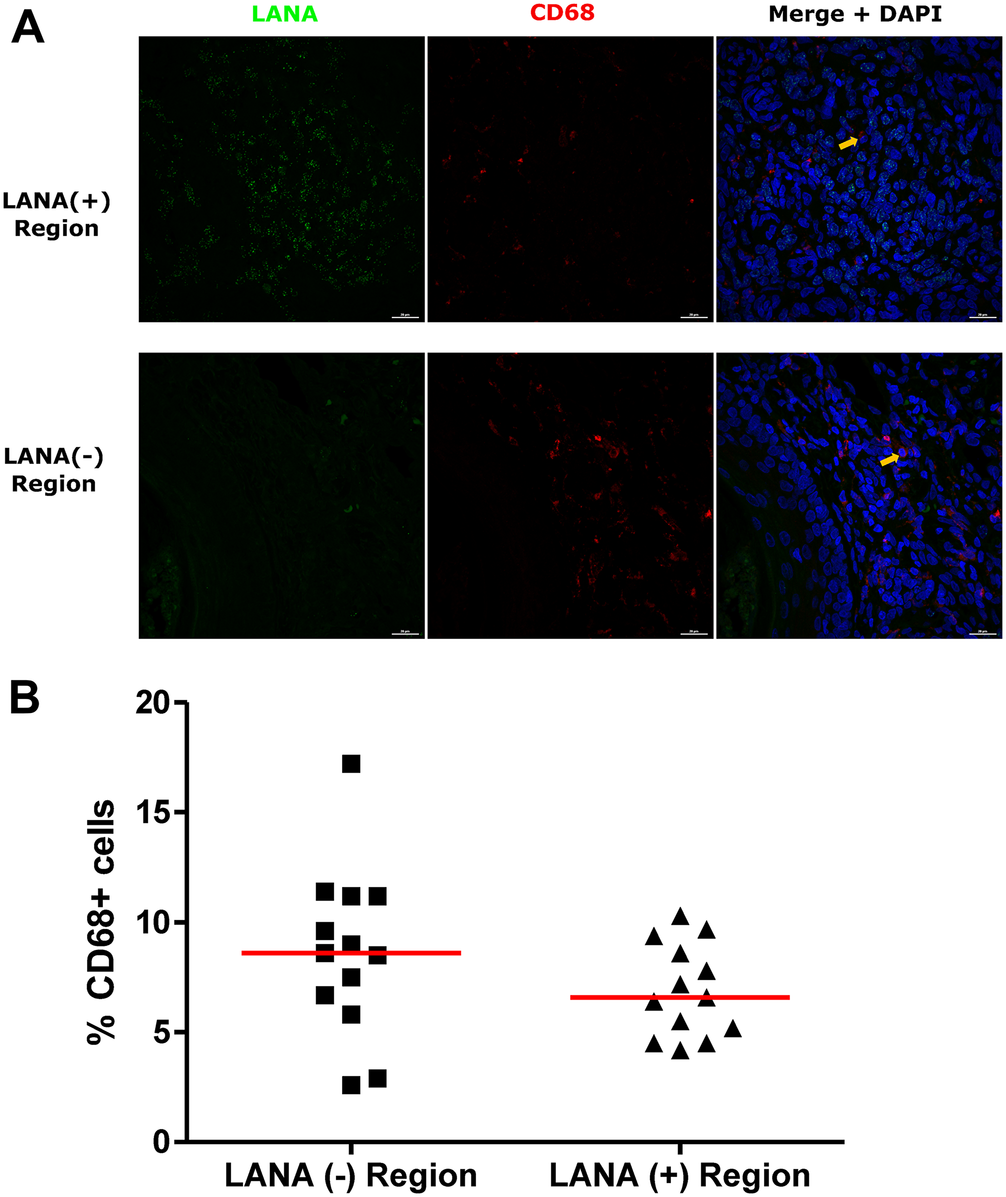 Dual-immunofluorescence staining of Kaposi’s Sarcoma-associated Herpesvirus (KSHV) Latency Associated Nuclear Antigen (LANA) protein and CD68 on Kaposi’s Sarcoma (KS) tissues