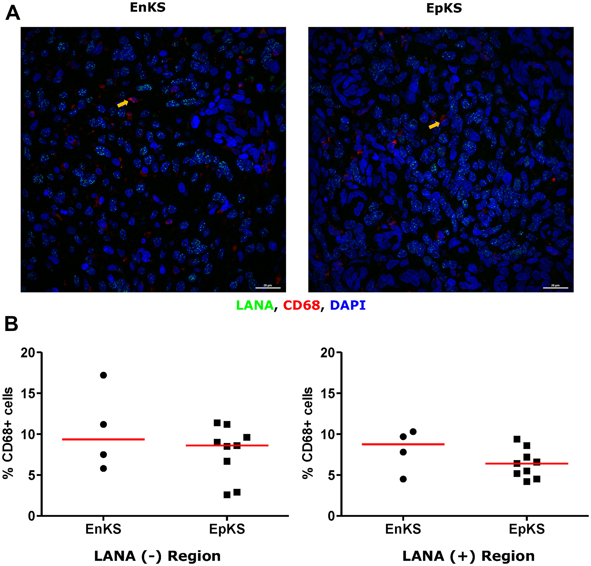 Dual-immunofluorescence staining of Kaposi’s Sarcoma-associated Herpesvirus (KSHV) Latency Associated Nuclear Antigen (LANA) protein and CD68 on Kaposi’s Sarcoma (KS) tissues