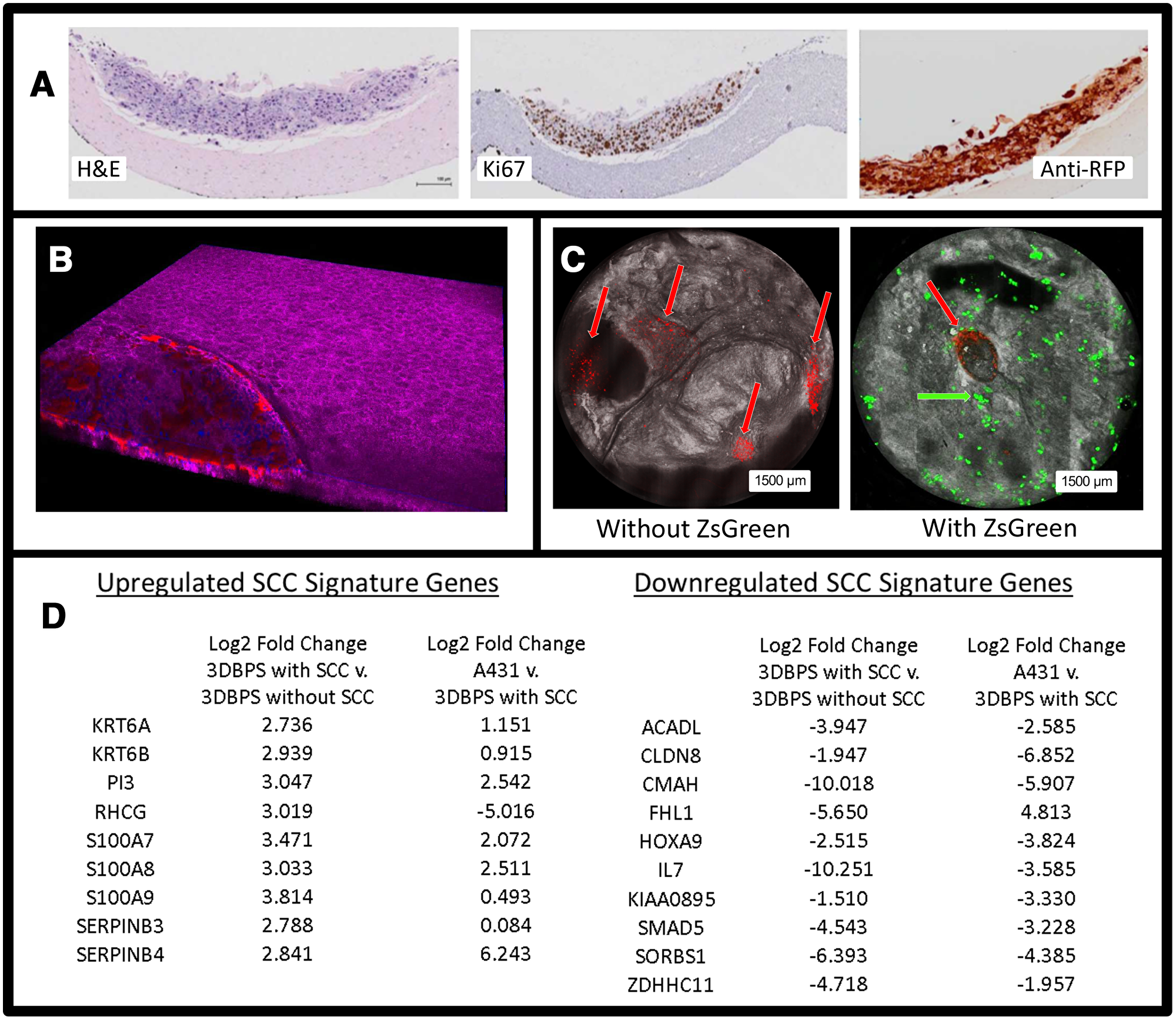 (A) H&E, Ki67, and Anti-RFP stained histology of 3DBPS model. (B) 3D confocal image of skin tissue with SCC tumor (purple: phalloidin staining, red: tdTomato red fluorescent protein (RFP) labeled SCC, blue: Hoescht staining). (C) Bimodal en face confocal microscopy of tdT-RFP-labeled cSCC (red arrows) in 3DBPS constructs with and without Zs-GFP-labeled neonatal keratinocytes (green arrow). All cSCC A431 cells are labeled with RFP while only 1% of keratinocytes are labeled with Zs-GFP resulting in sparsity of the green signal. (D) SCC signature genes that are up- and down-regulated in A431 cells grown in vitro and untreated full thickness 3DBPS without SCC spheroids compared to 3DBPS with SCC spheroids. Log2 fold change is normalized to Keratin 10.