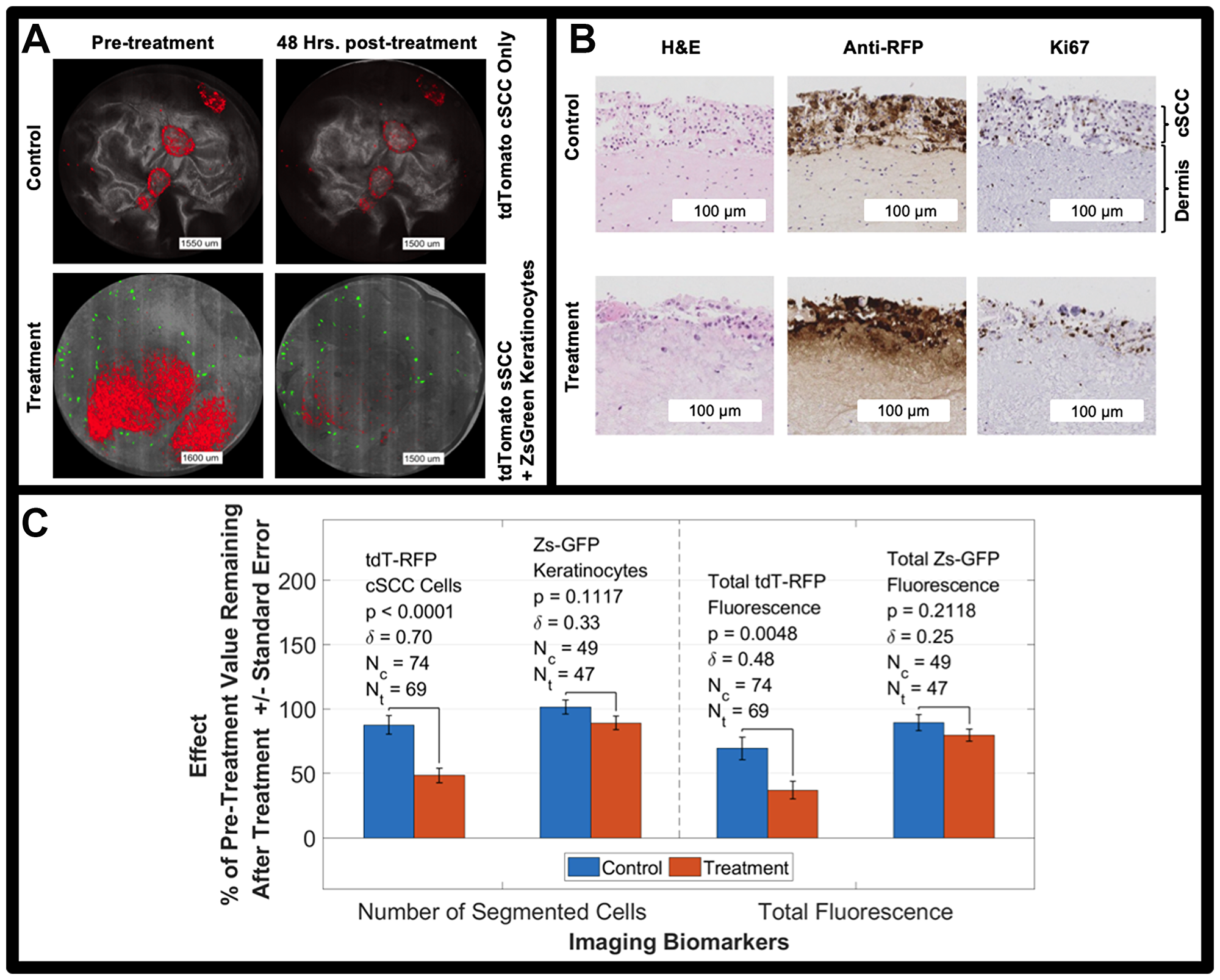 (A) Bimodal imaging examples of control and treated tumors (red) before and after the treatment period. cSCC tumors are red, reflectance is grayscale, and keratinocytes are green. All cSCC A431 cells are labeled with RFP while only 1% of keratinocytes are labeled with Zs-GFP resulting in sparsity of the green signal. (B) H&E, Ki67, and Anti-RFP antibody staining of untreated (control) tumor model and tumor model treated with 5FU for 48 hours. (C) 5FU treatment effect on tdT-RFP-labeled cSCC spheroids and Zs-GFP-labeled keratinocytes including p-value and effect size, δ. Two imaging biomarkers are shown, number of segmented objects and total fluorescence of the size-thresholded segmented objects. NOTE: the fluorescence in panel A is intentionally saturated for display.