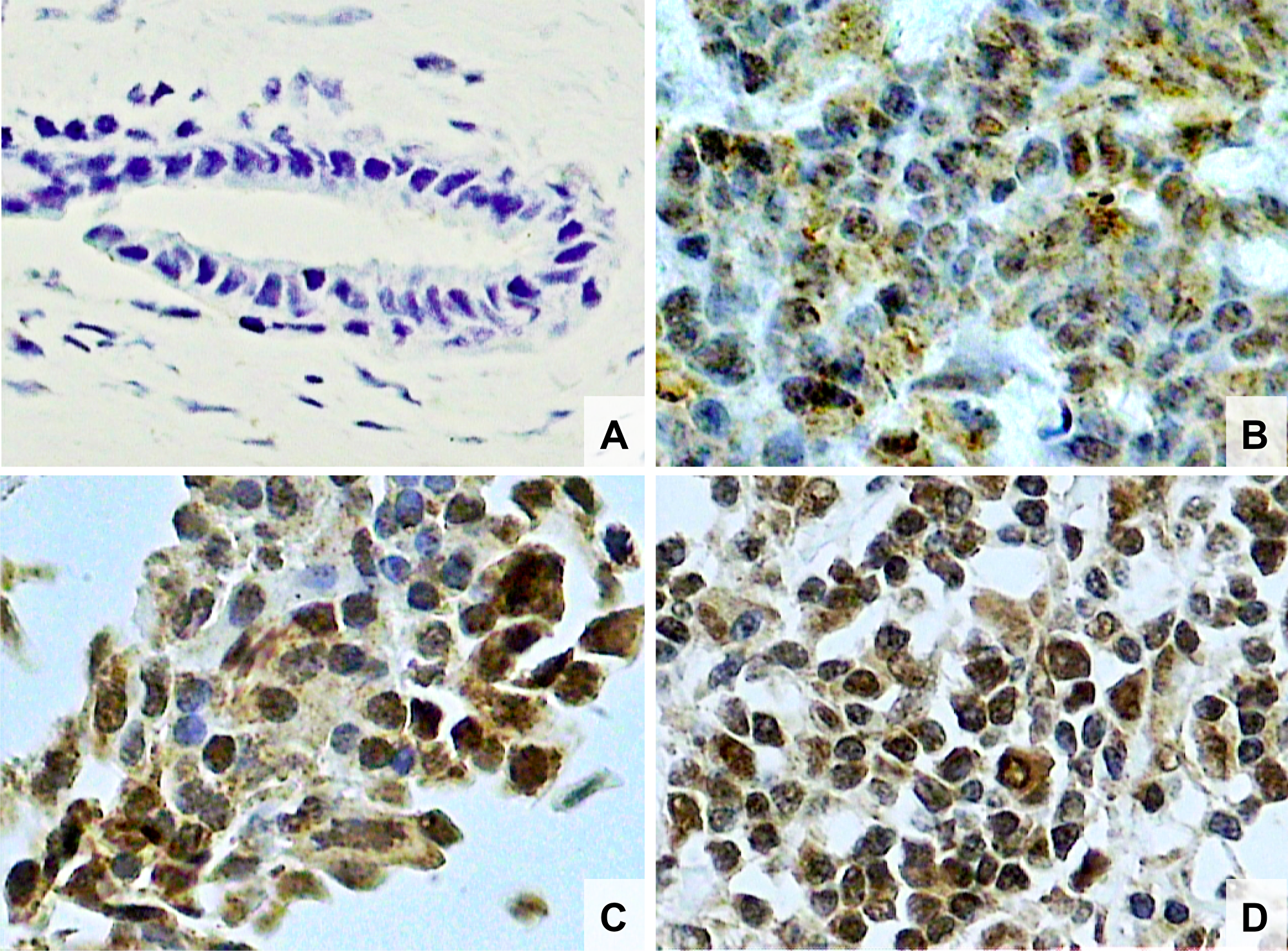 Photomicrographs of histological sections of breast fibroadenoma (A), histological grade 1 breast cancer (B), grade 2 breast cancer (C) and grade 3 breast cancer (D). Note the higher concentration of Nrf2 stained nuclei in breast cancer cells compared to fibroadenoma cells and also a higher concentration of Nrf2 stained nuclei in histological grade 3 than grade 2 and higher in grade 2 than grade 1 breast cancer (original magnifcation × 400).