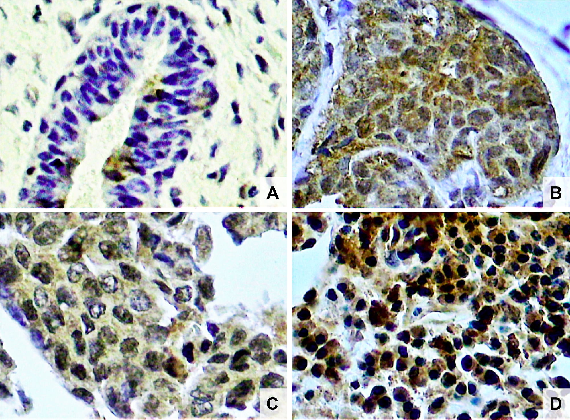 Photomicrographs of histological sections of breast fibroadenoma (A), histological grade 1 breast cancer (B), grade 2 breast cancer (C) and grade 3 breast cancer (D). Note the higher concentration of NF-κB stained nuclei in breast cancer cells compared to fibroadenoma cells, and also a higher concentration of NF-κB stained nuclei in histological grade 3 than grade 1 breast cancer (original magnifcation × 400).