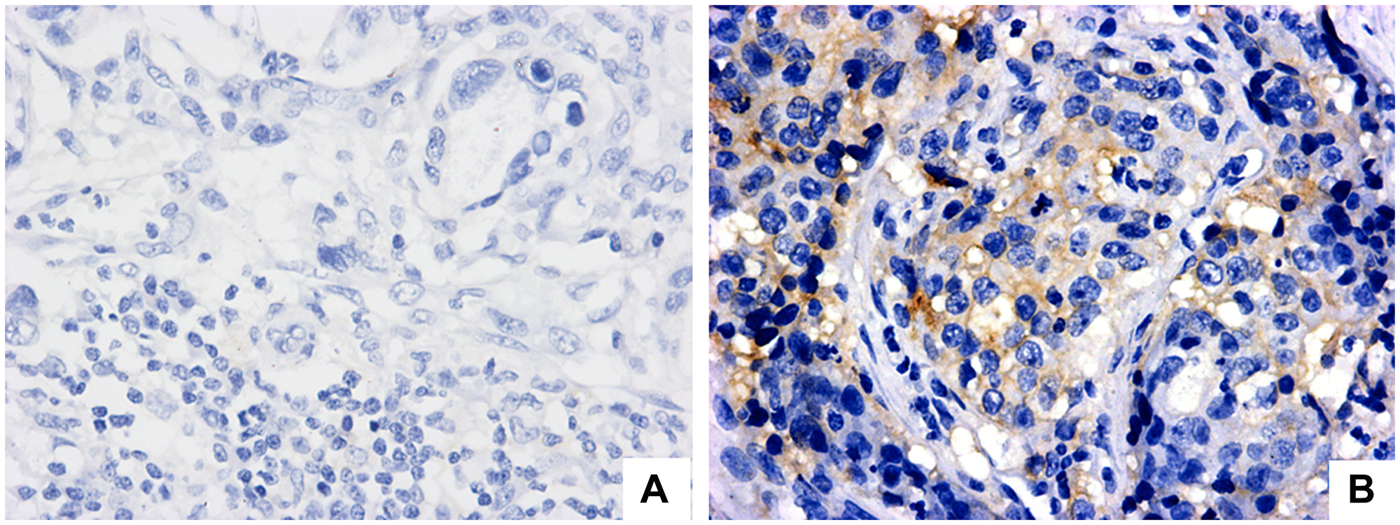 PD-L1 expression evaluation in regional lymph node with metastatic gastric adenocarcinoma (positive lymph node)