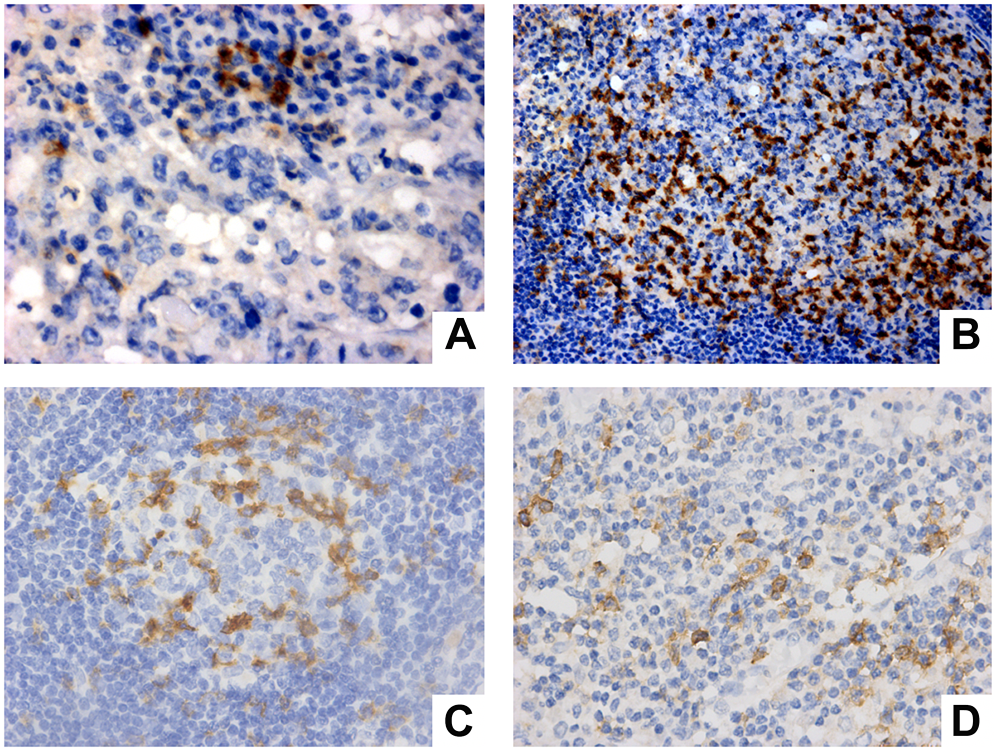 PD-1 expression evaluation in immune cells from positive lymph node (A, B) and negative lymph node (C, D). (A) PD-1 expression in T lymphocytes (Magnification 40×). (B) expression in centrofollicular B lymphocytes (Magnification 20×). (C) PD-1 expression in centrofollicular B lymphocytes of negative lymph node (Magnification 40×). (D) PD-1 expression in macrophage and T lymphocytes (magnification 40×).