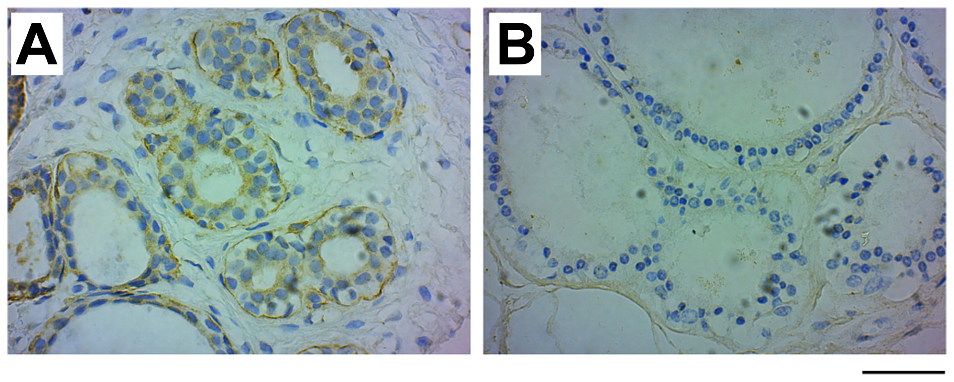 GRB7 expression in benign fibroadenoma and fibrocystic changes