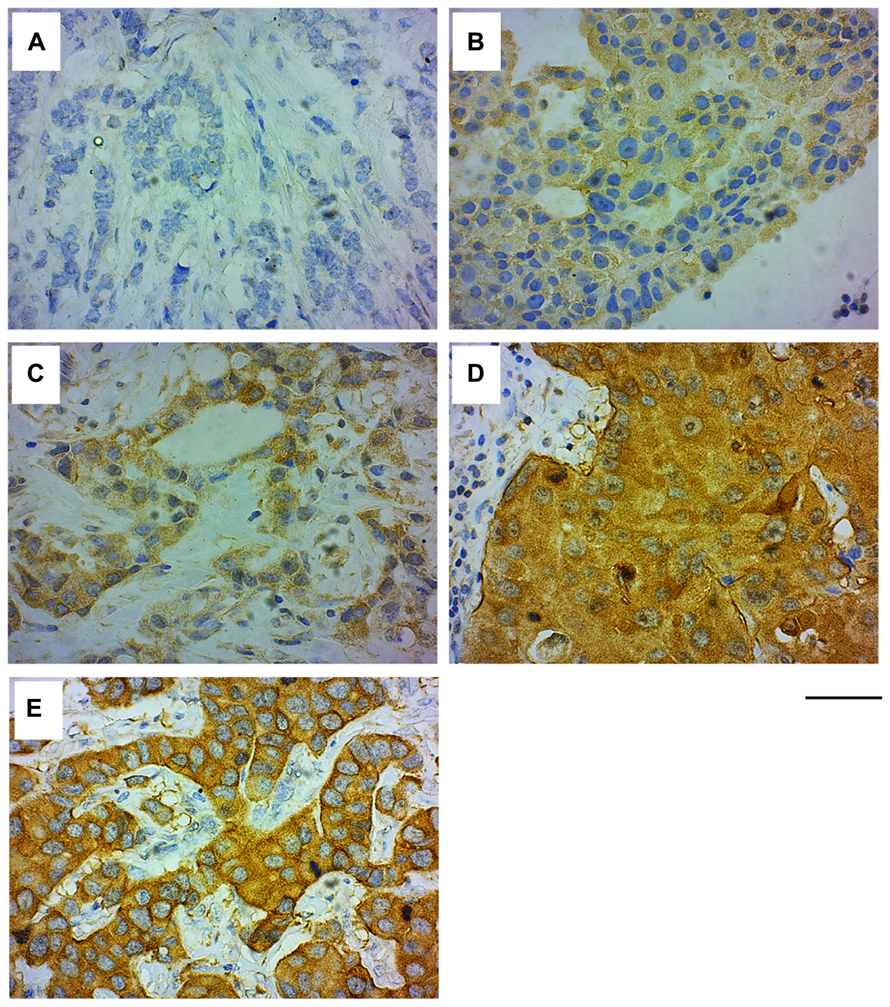 GRB7 expression and localization in invasive ductal carcinoma (IDC) of the breast