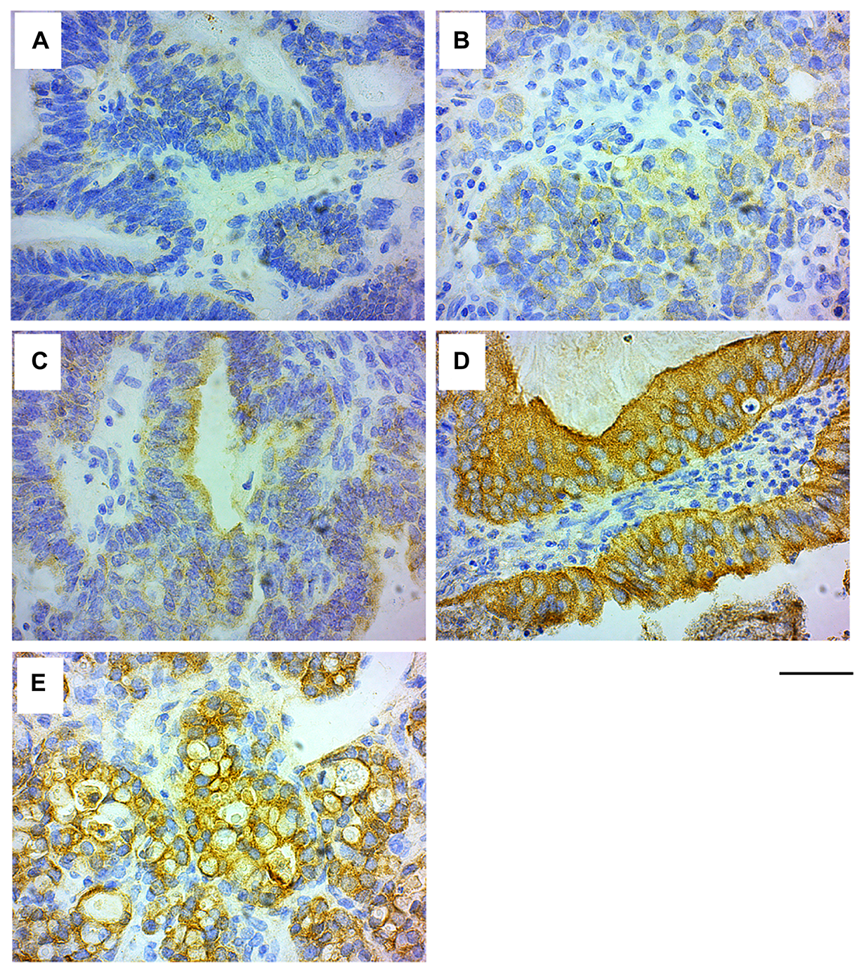 GRB7 expression in ovarian carcinoma cells
