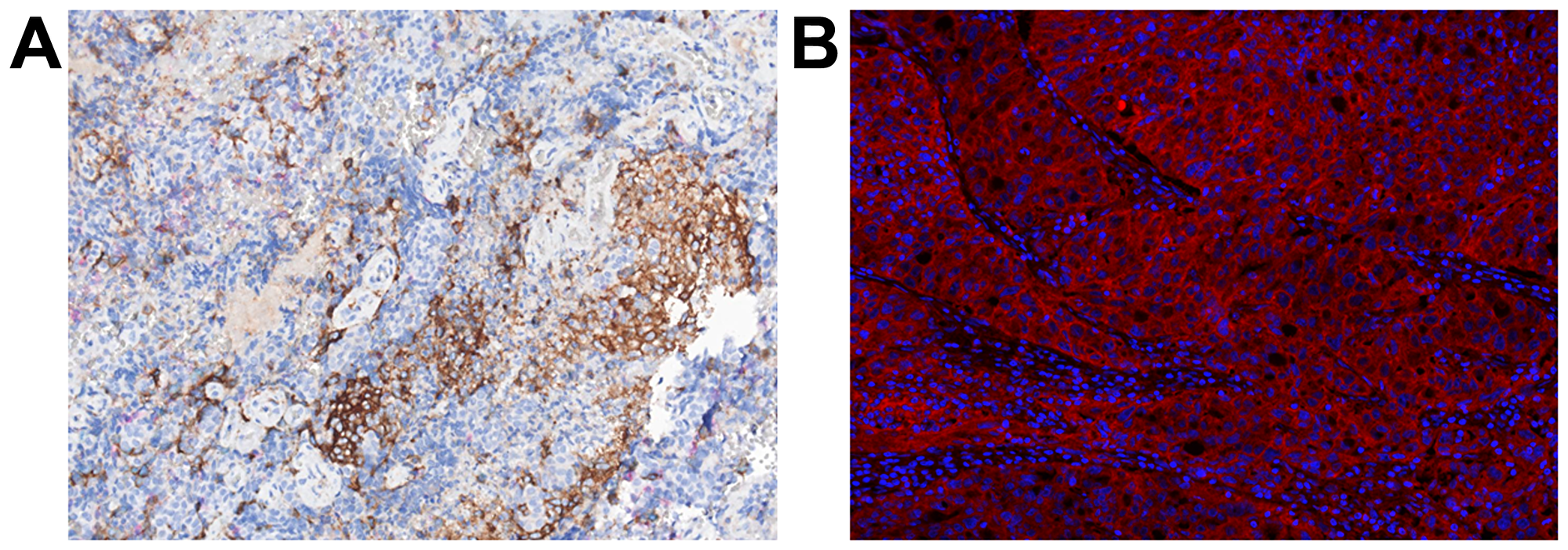 Immunohistochemistry and immunofluorescence of tumor tissue