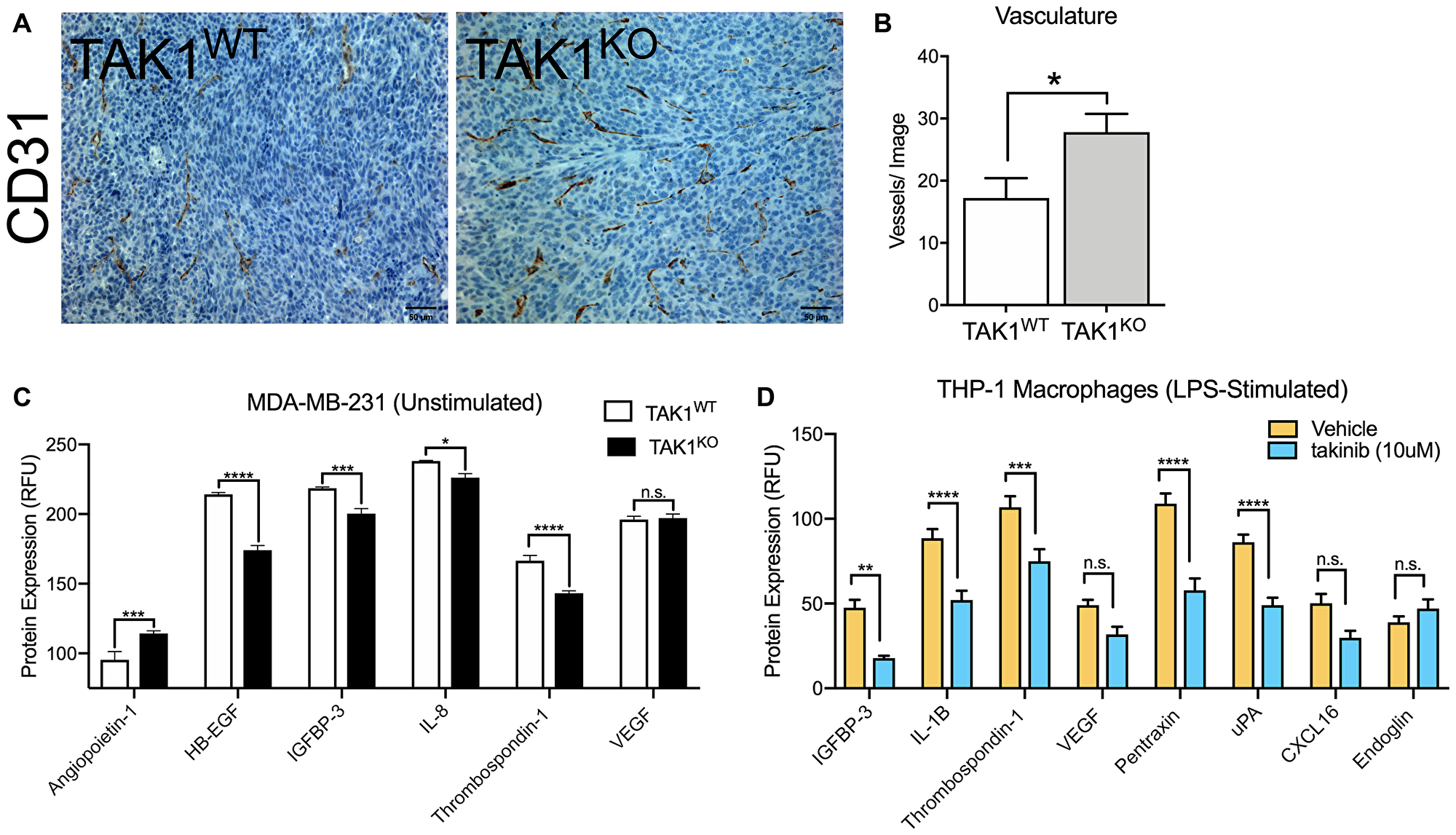 The role of TAK1 in cancer cell and macrophage vasculature
