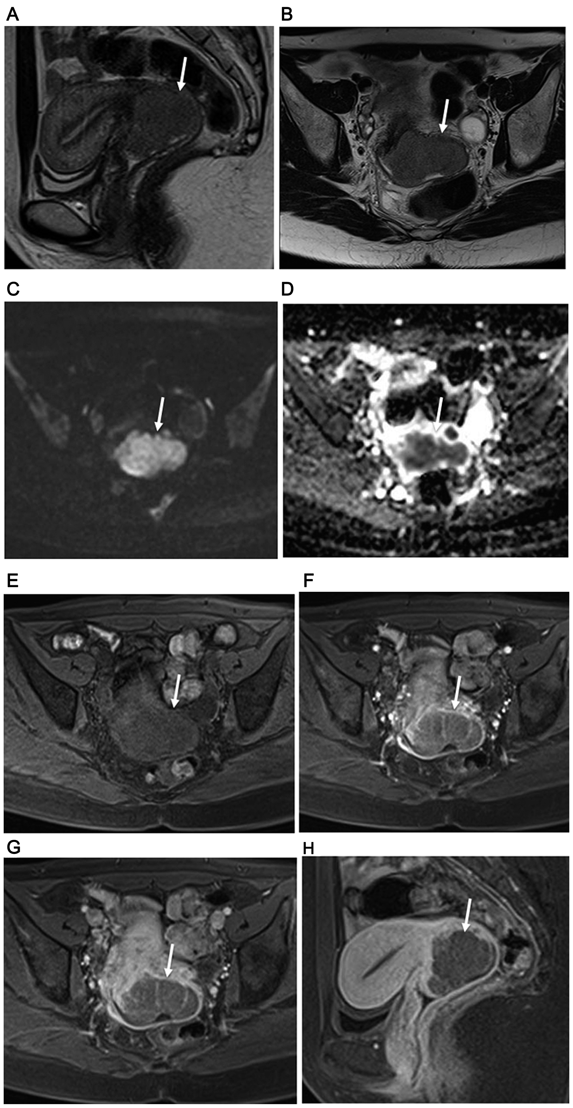 34-year-old woman with FIGO stage IB2 uterine cervical large cell neuroendocrine carcinoma
