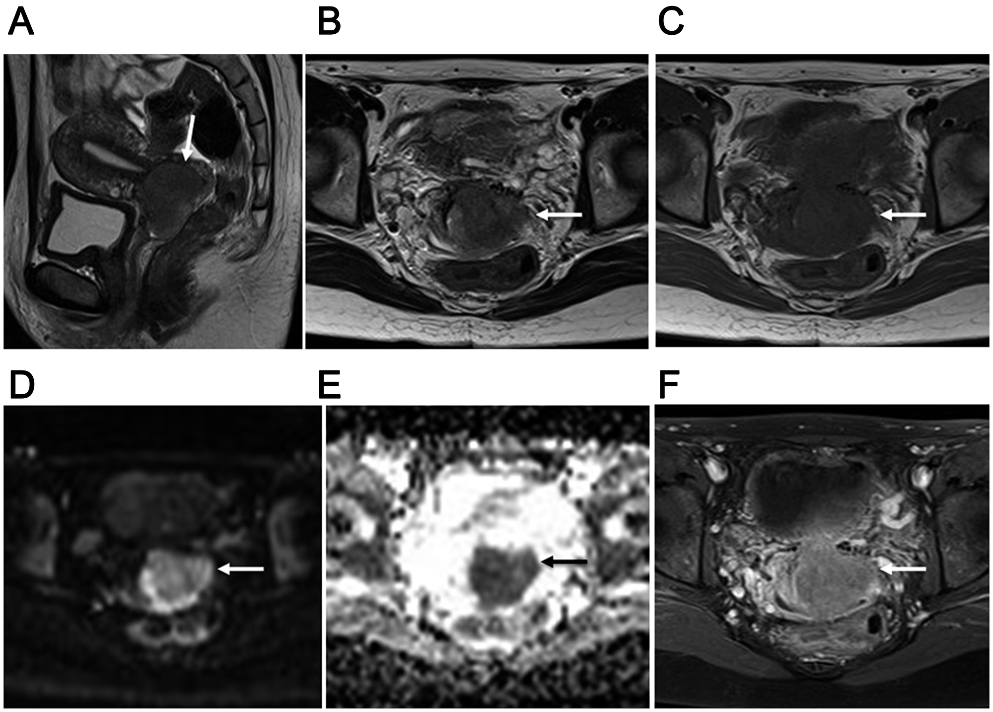 34-year-old woman with FIGO stage IIB2 uterine cervical small cell neuroendocrine carcinoma