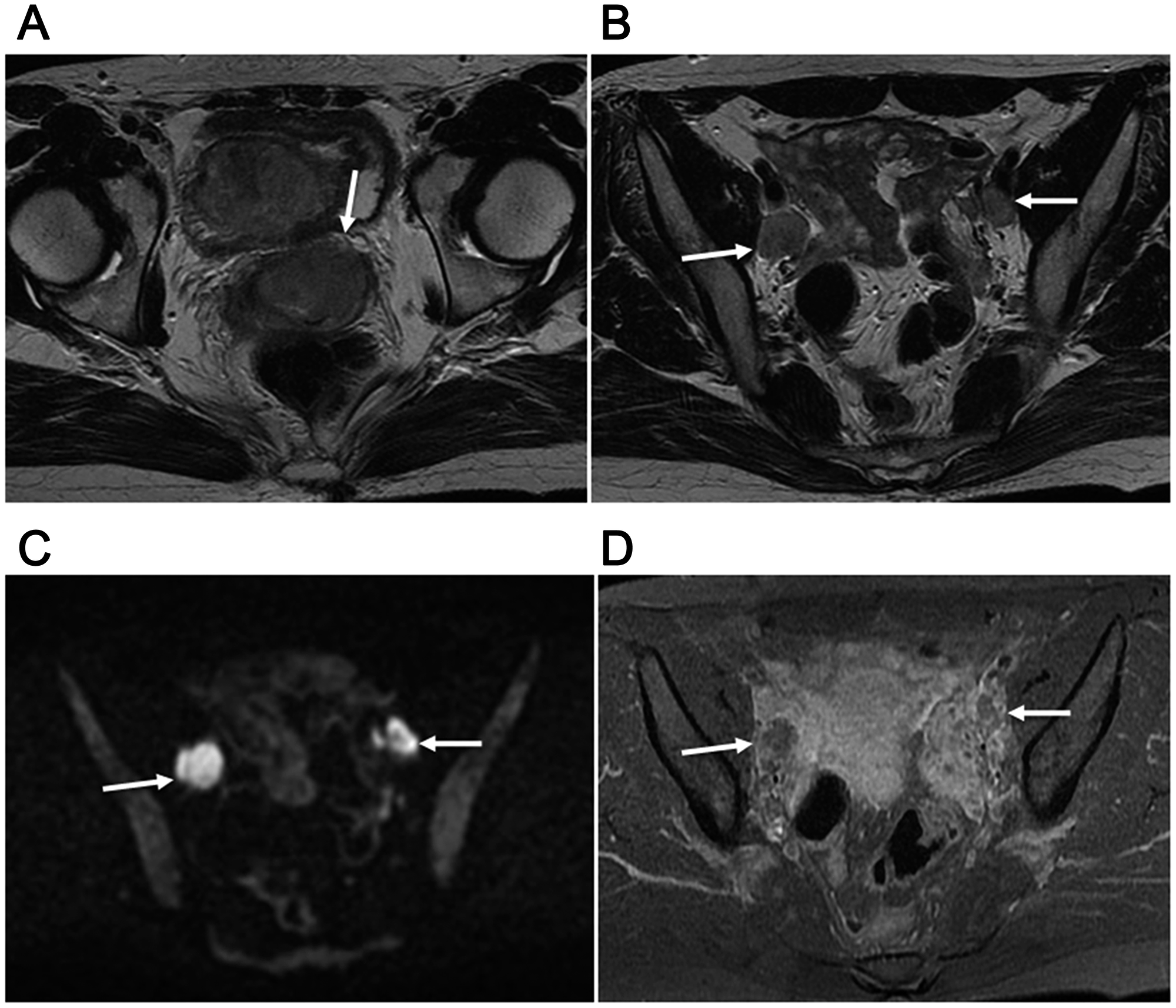 30-year-old woman with T2bN1M0 (stage IIIB) and FIGO stage IIB2 uterine cervical small cell carcinoma mixed with squamous cell carcinoma