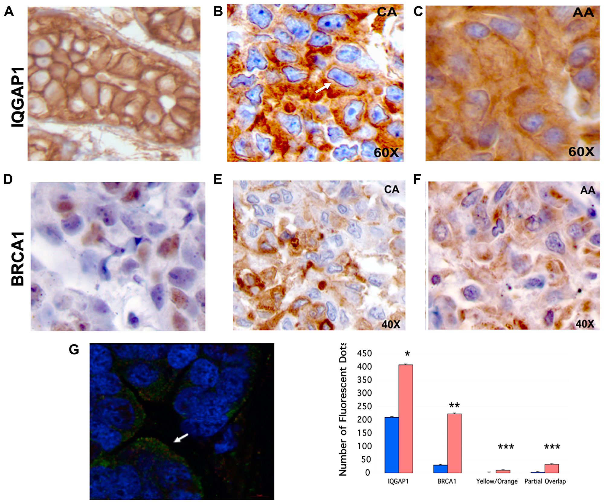 Mislocalization of IQGAP1-BRCA1 in human TNBC tumors phenocopies the dominant mutants and the TNBC cells