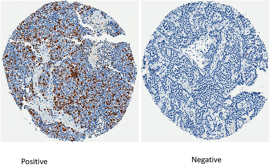 Immunohistochemistry staining for survivin
