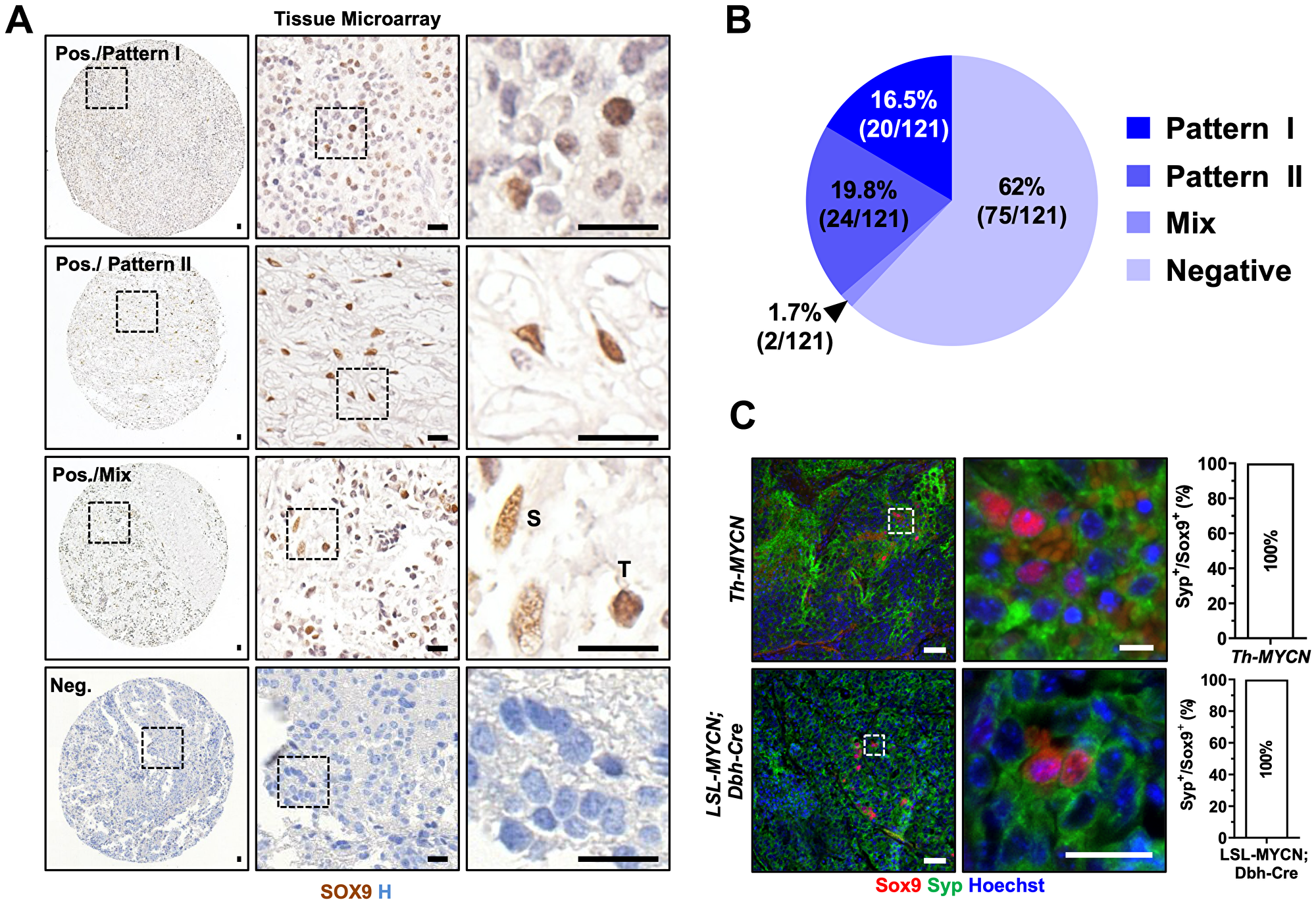 SOX9 is expressed in tumorigenic neuroblasts in human and mouse neuroblastoma samples