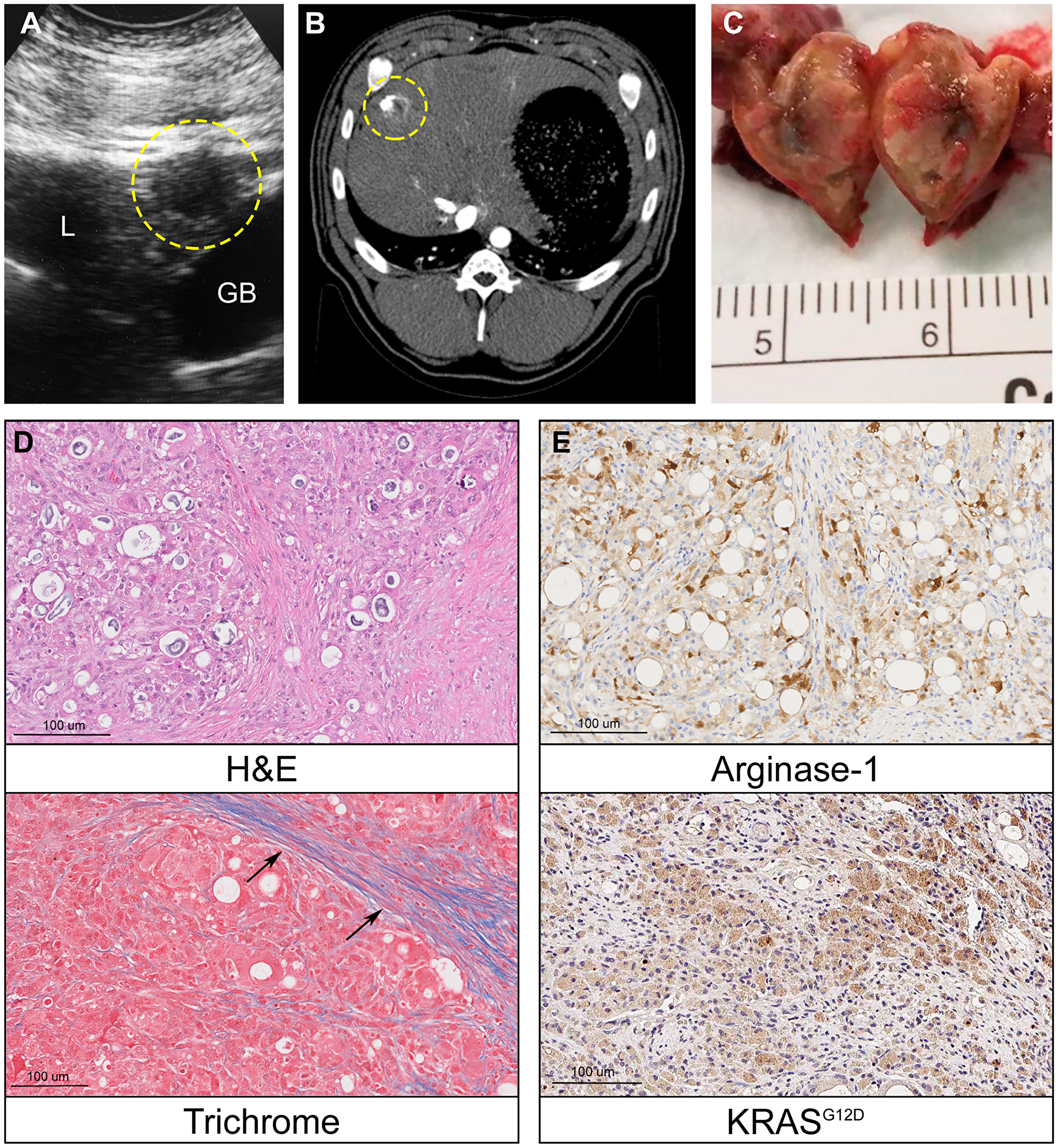 Oncopig intrahepatic HCC tumor formation