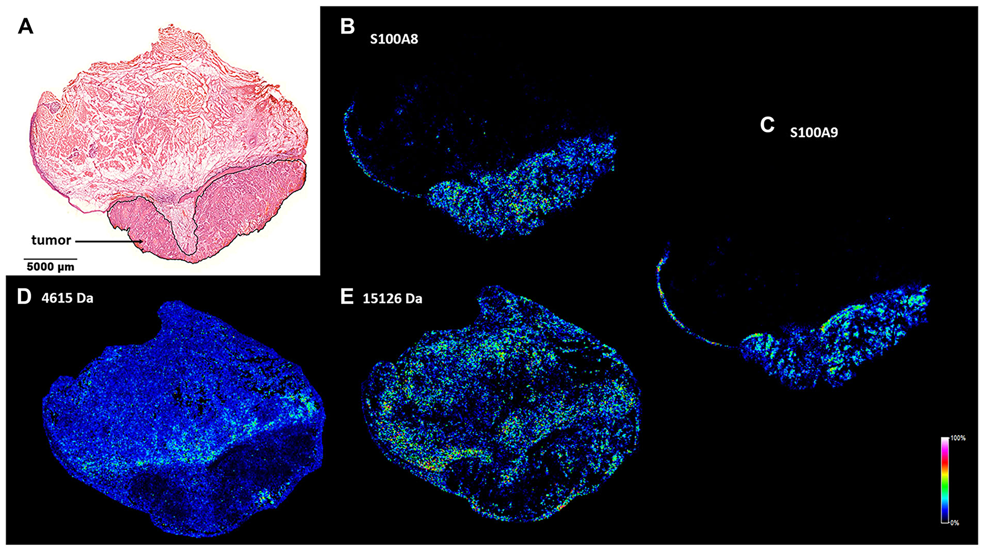 Spatial distribution of tumor marker candidate proteins in a HNSCC clinical specimen