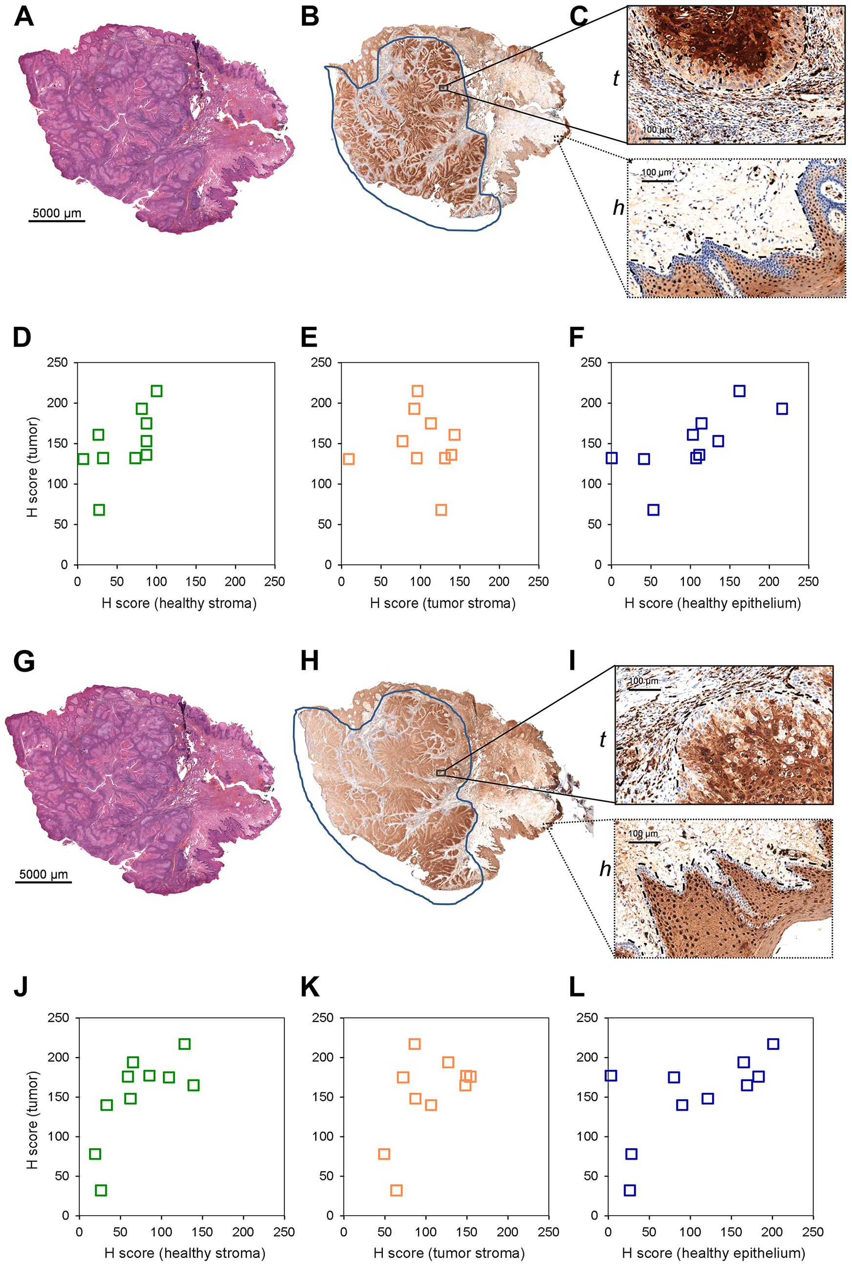S100A8 and S100A9 staining of paraffin embedded clinical HNSCC samples by immunohistochemistry