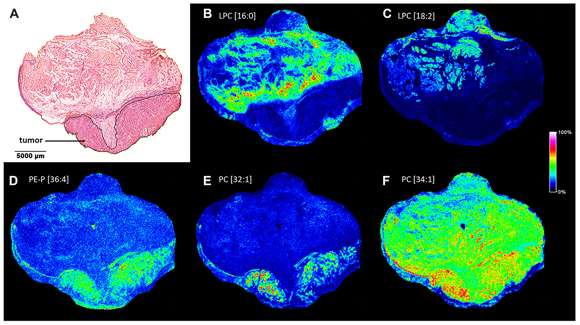 Lipid MS images of the HNSCC sample