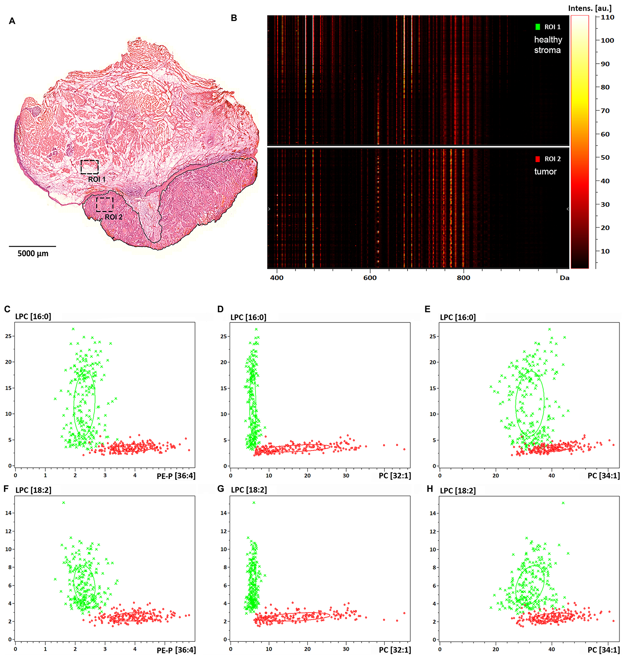 Lipid expression and spatial distribution analysis of biopsy size regions of the tissue sample