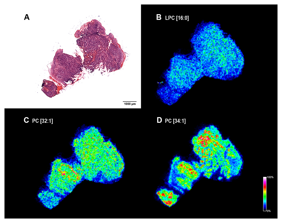 Lipid MS images of a HNSCC biopsy
