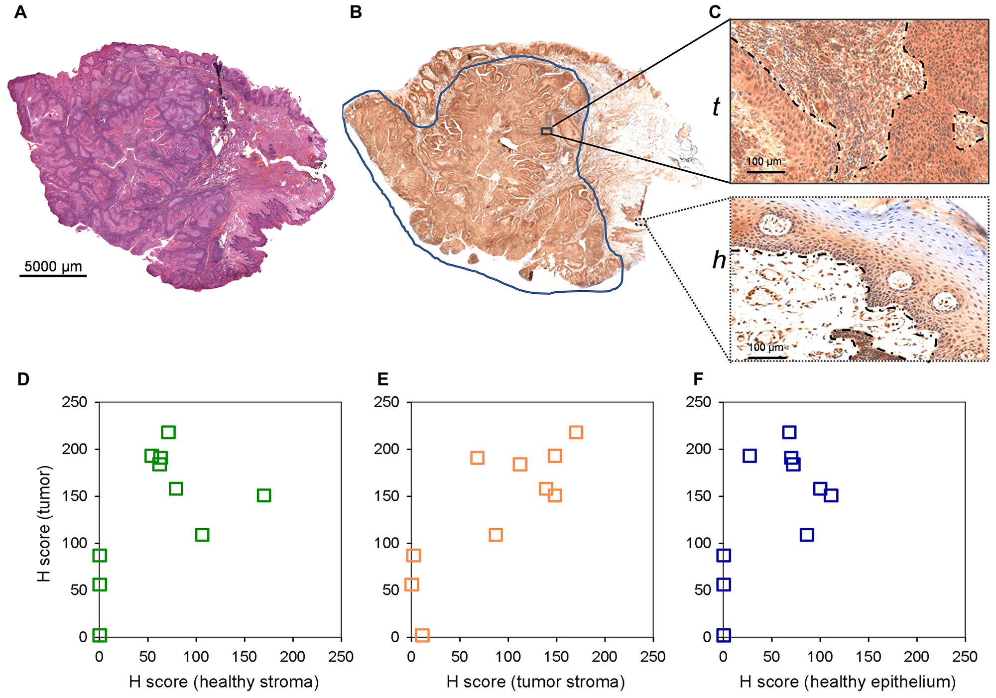 LYPLA1 staining of paraffin embedded clinical HNSCC samples by immunohistochemistry