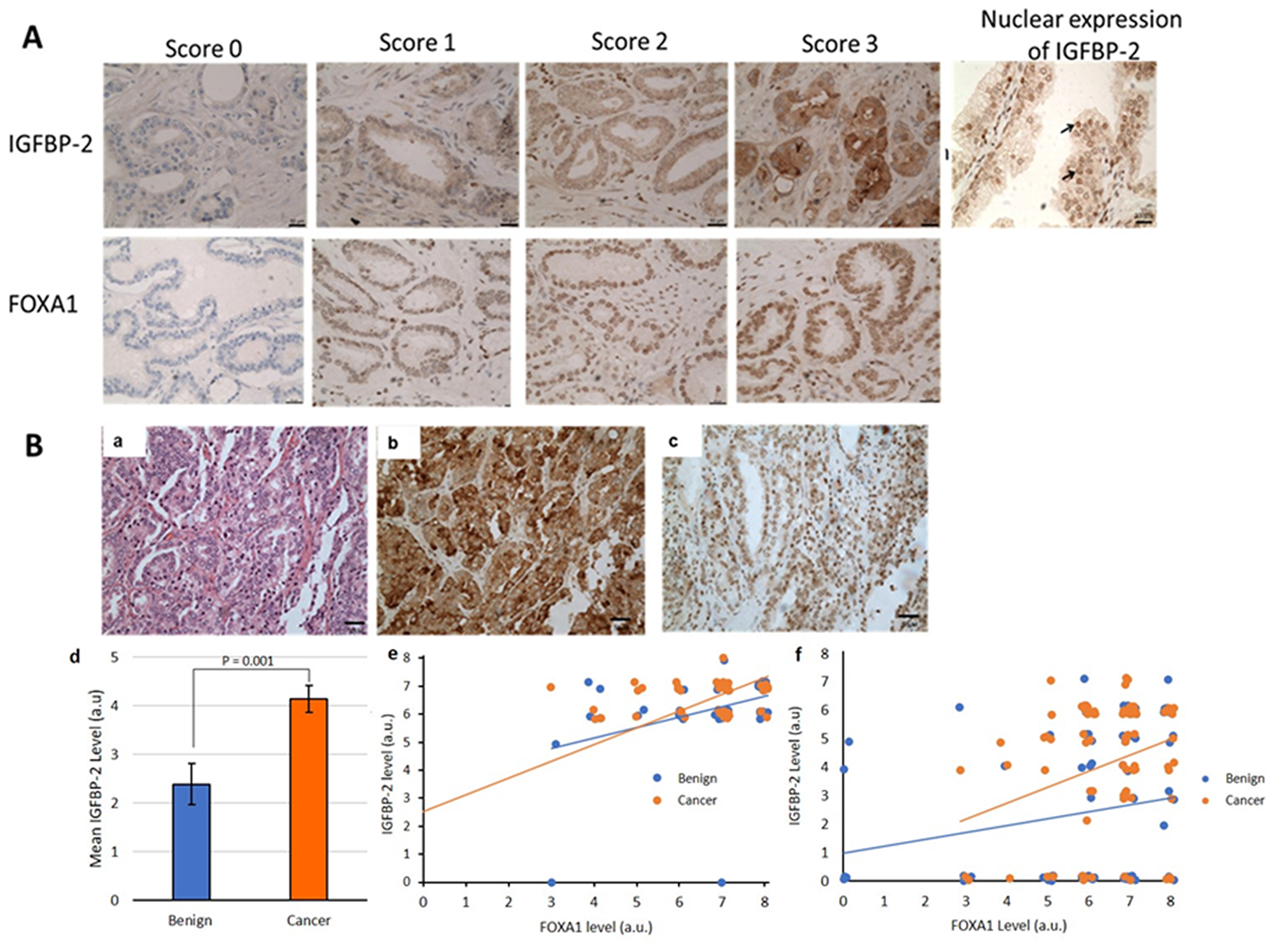 (A) IGFBP-2 and FOXA1 expression in prostate cancer tissue. Tissue demonstrating negative staining (0 score), weak staining (1 score), moderate staining (3 score), strong staining (3 score) (×20 magnification) and positive IGFBP-2 nuclear expression in prostate epithelial cells (see →) (×40 magnification). (B) Association between FOXA1 and IGFBP-2 levels in prostate cancer tissue. (a) Hematoxylin and Eosin staining (b) strong IGFBP-2 and (c) FOXA1 staining in the same prostate cancer tissue (×20 magnification). (d) bar chart showing the significant increase in IGFBP-2 expression in cancer compared to benign tissue in the PrEvENT cohort and scatter plots showing the significant positive association between FOXA1 and IGFBP-2 proteins level in prostate cancer tissue in the Southmead (e) and PrEvENT (f) cohorts.