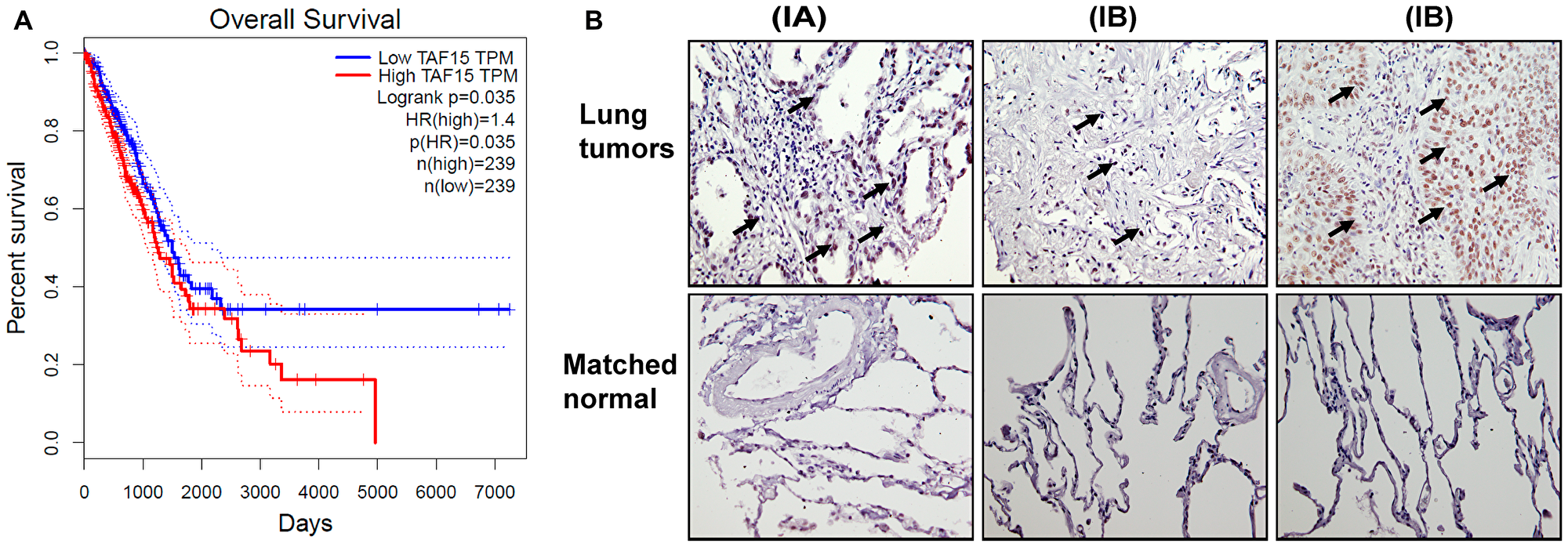 TAF15 is overexpressed in NSCLC that correlates to poor overall survival