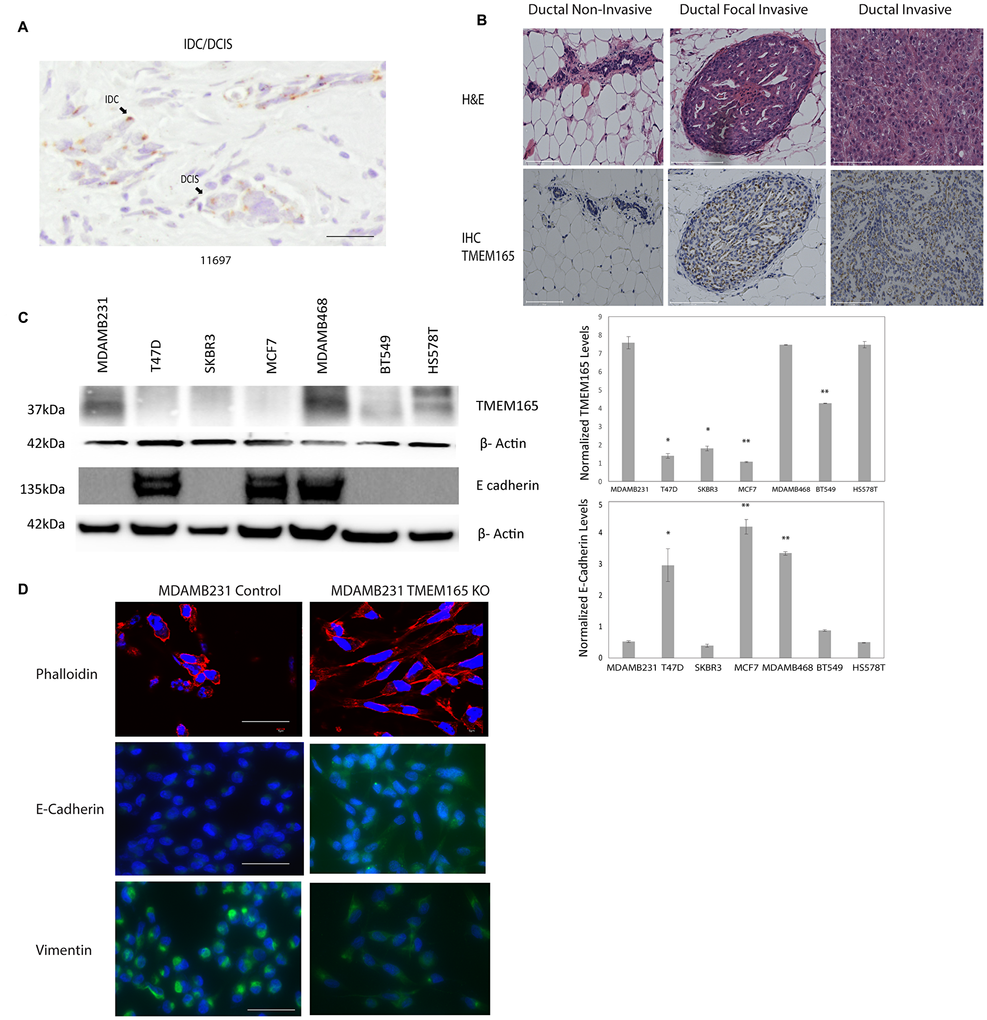 TMEM165 is increased in human breast cancer tissues and cell lines