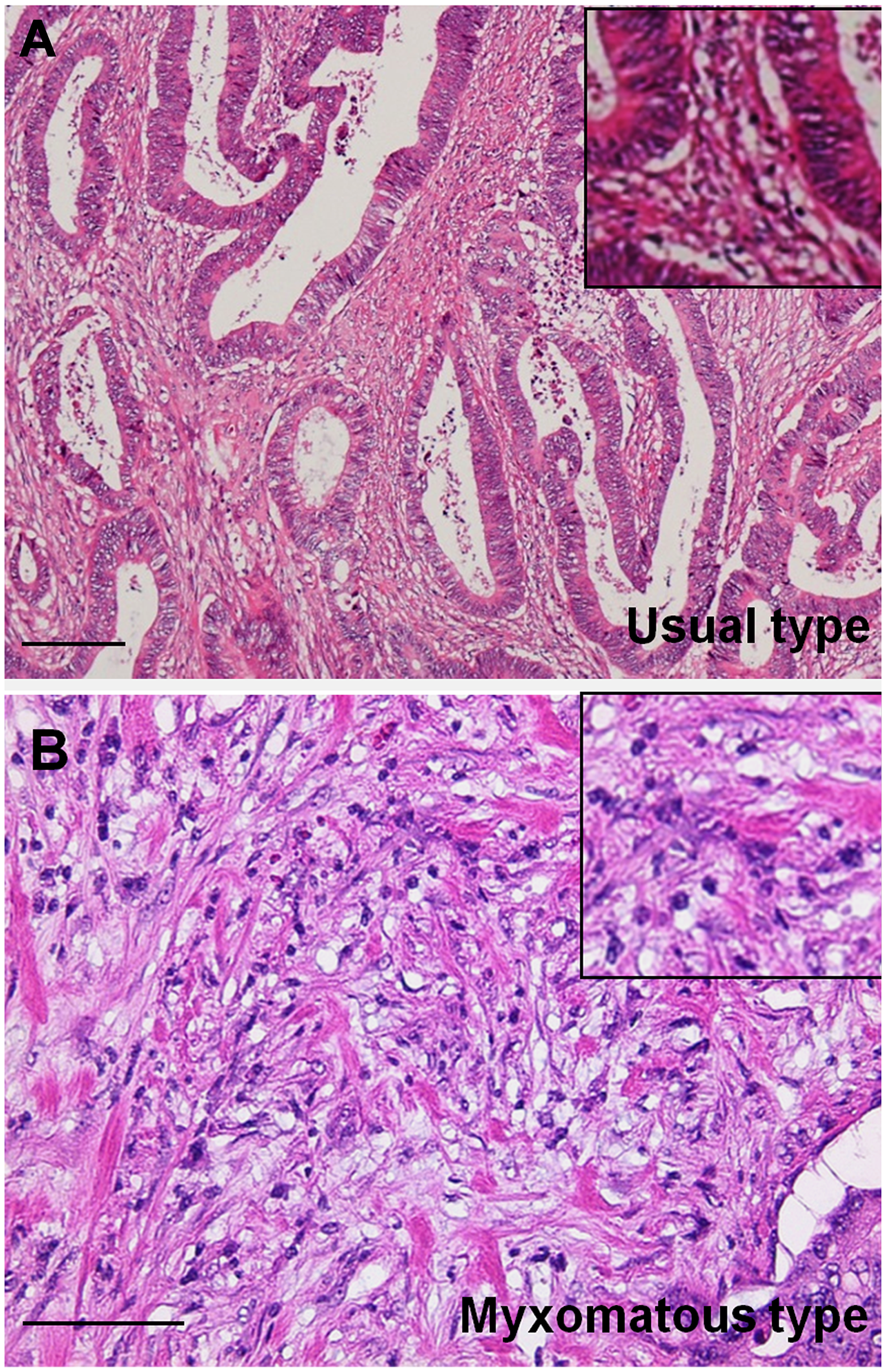 Histopathological findings of myxomatous stroma in colorectal cancer