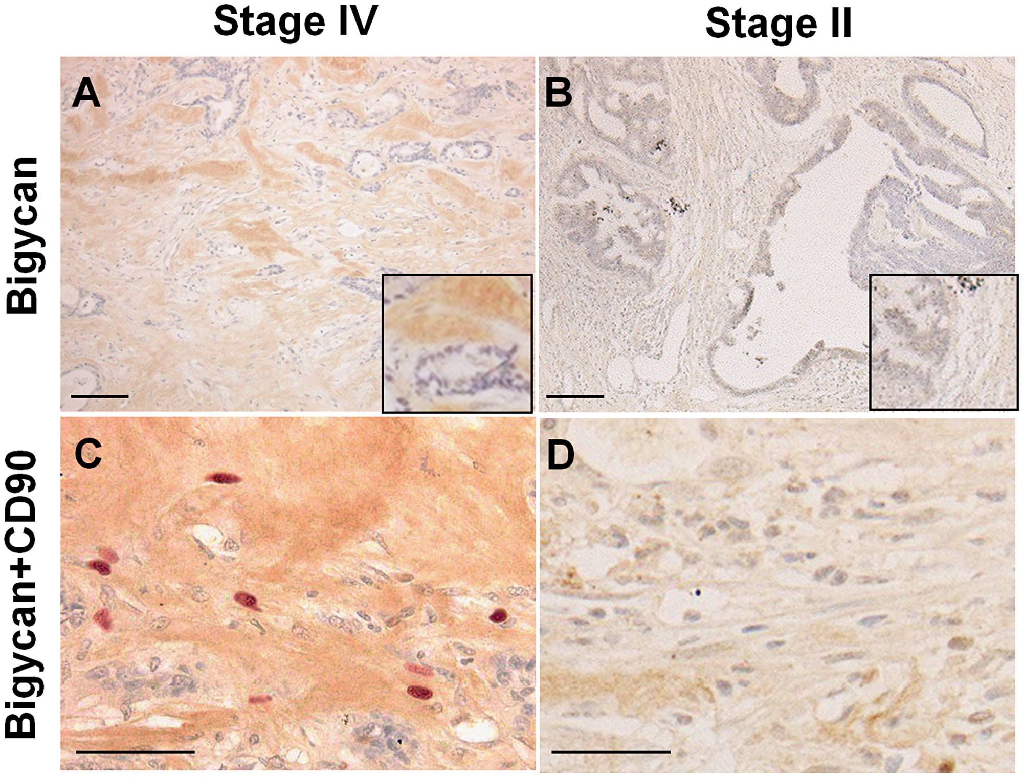 Expression of biglycan and CD90-positive mesenchymal stem cells in cancer stroma